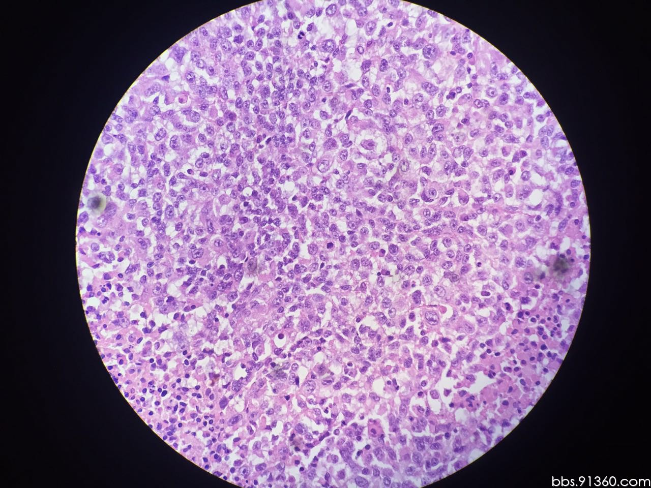 左大腿根部 精原细胞瘤 9.8【91360软组织与骨沙龙病例94】