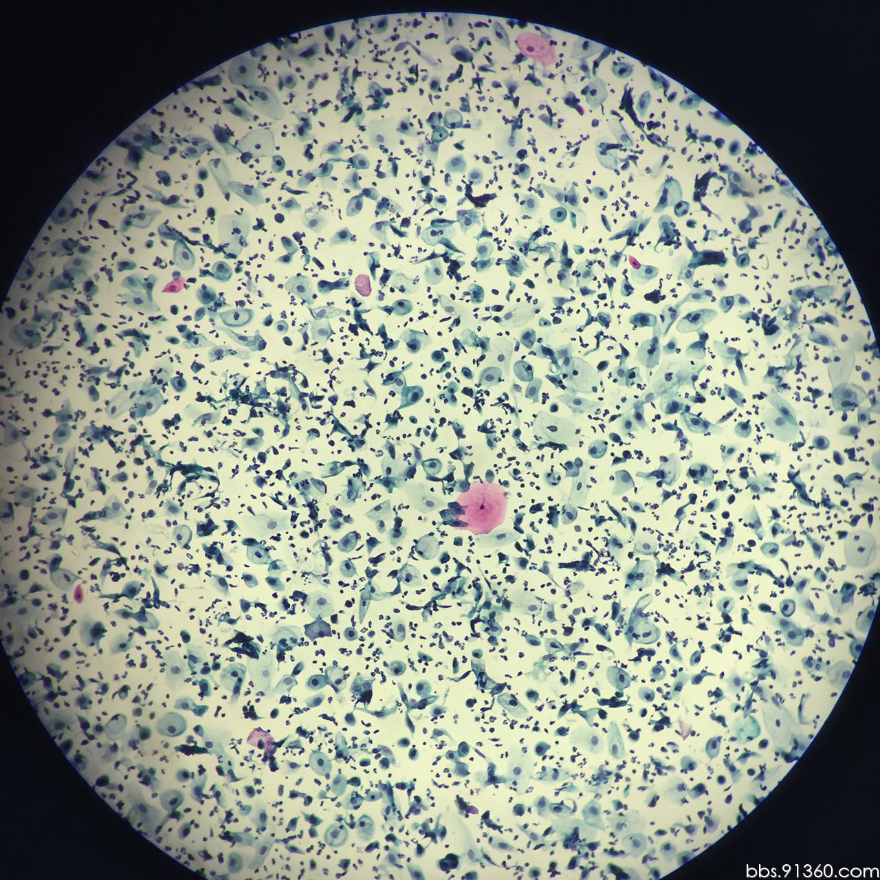 女,48岁,宫颈tct,这样的细胞是判读hpv还是糖原空泡?