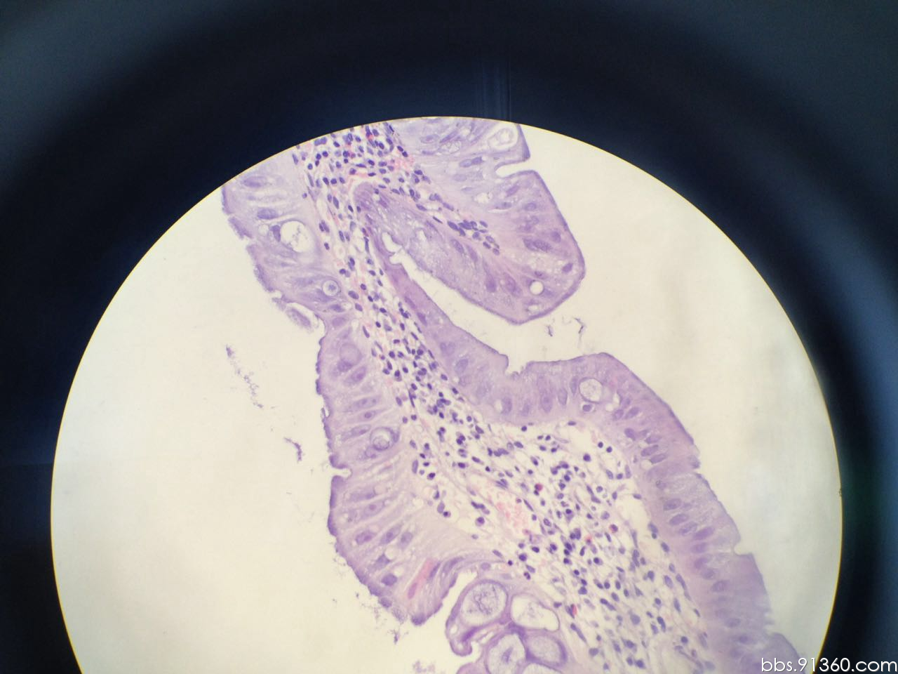 2*3cm绒毛状息肉2016.10.25【91360消化沙龙病例175】