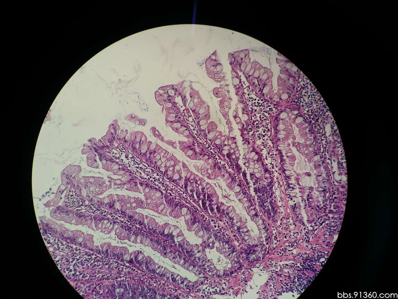 无蒂锯齿状腺瘤2016.11.9【91360消化沙龙病例192】