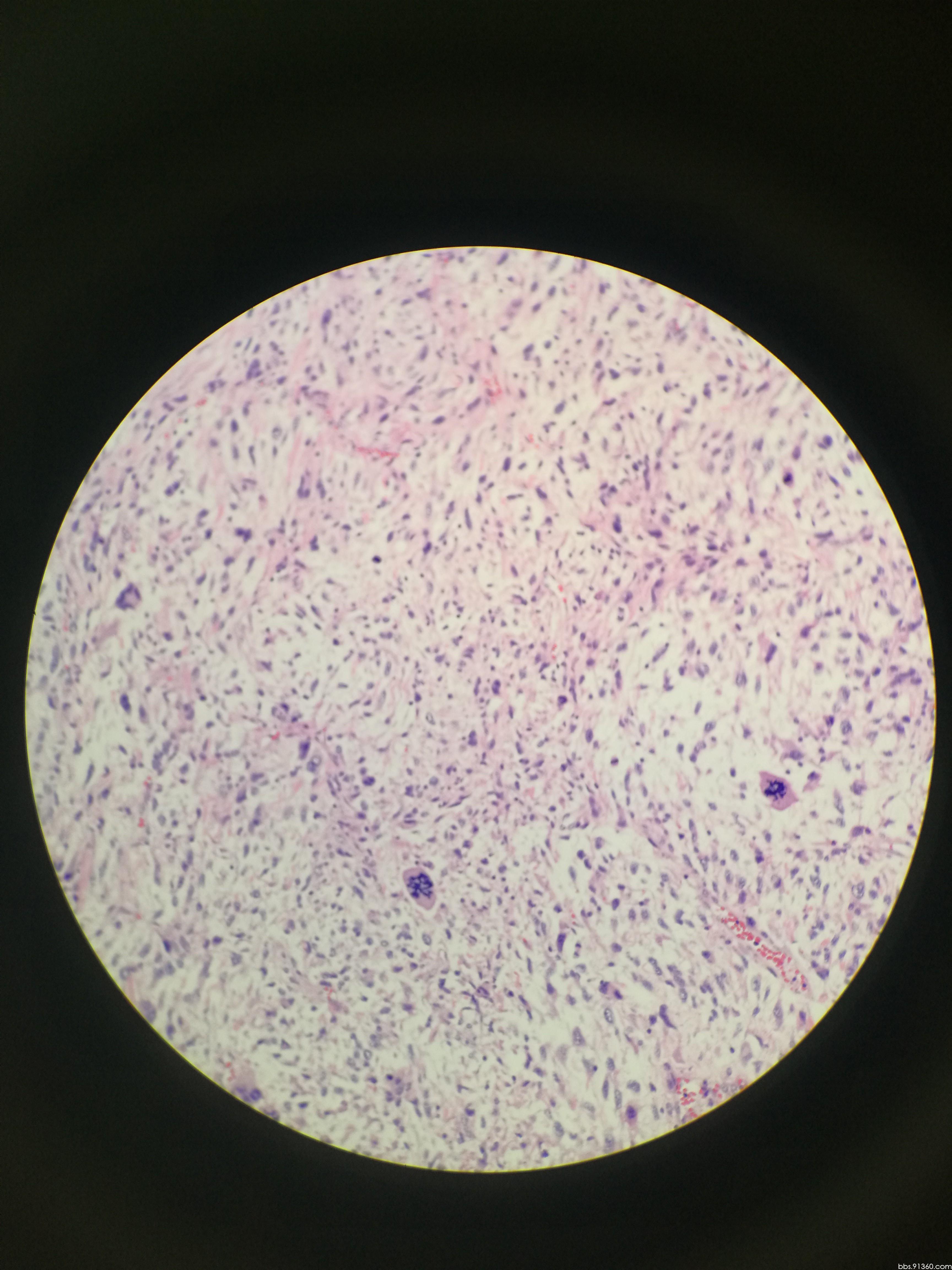 胸壁,浆细胞瘤2016/11/14【河南病理交流群病例1】