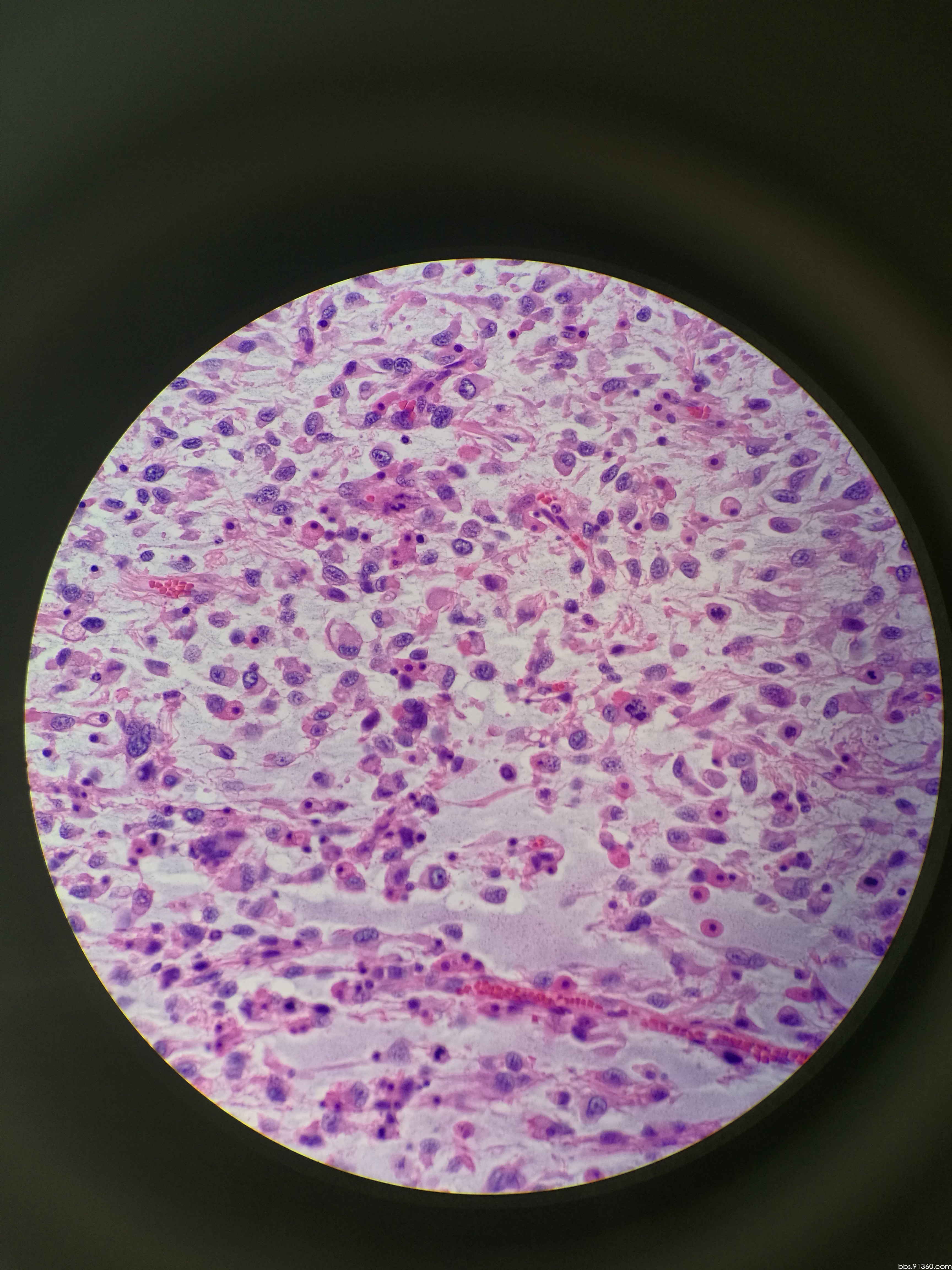 胸壁,浆细胞瘤2016/11/14【河南病理交流群病例1】