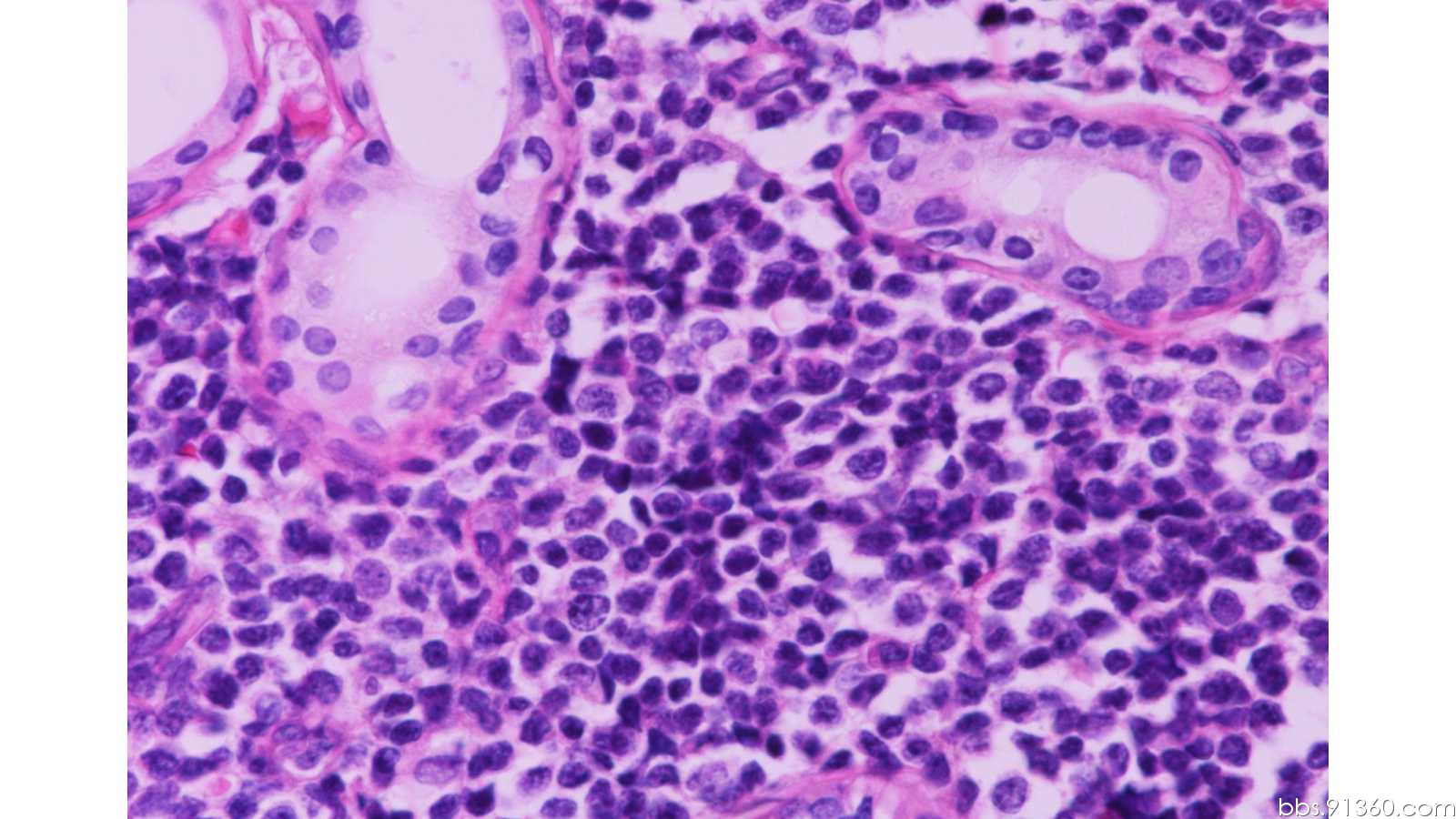睾丸浆细胞瘤