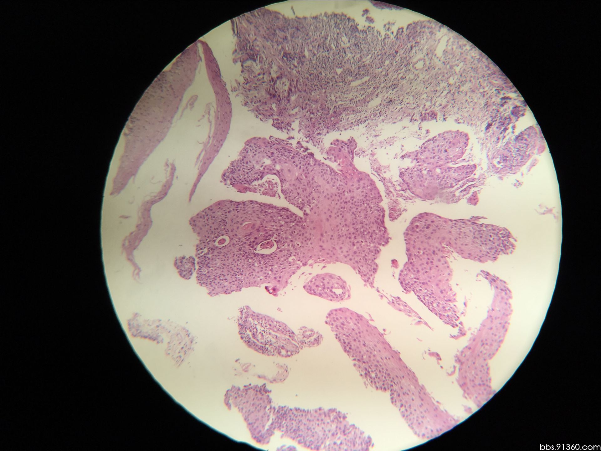 食管鳞状细胞癌