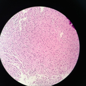 颗粒细胞瘤病理图片