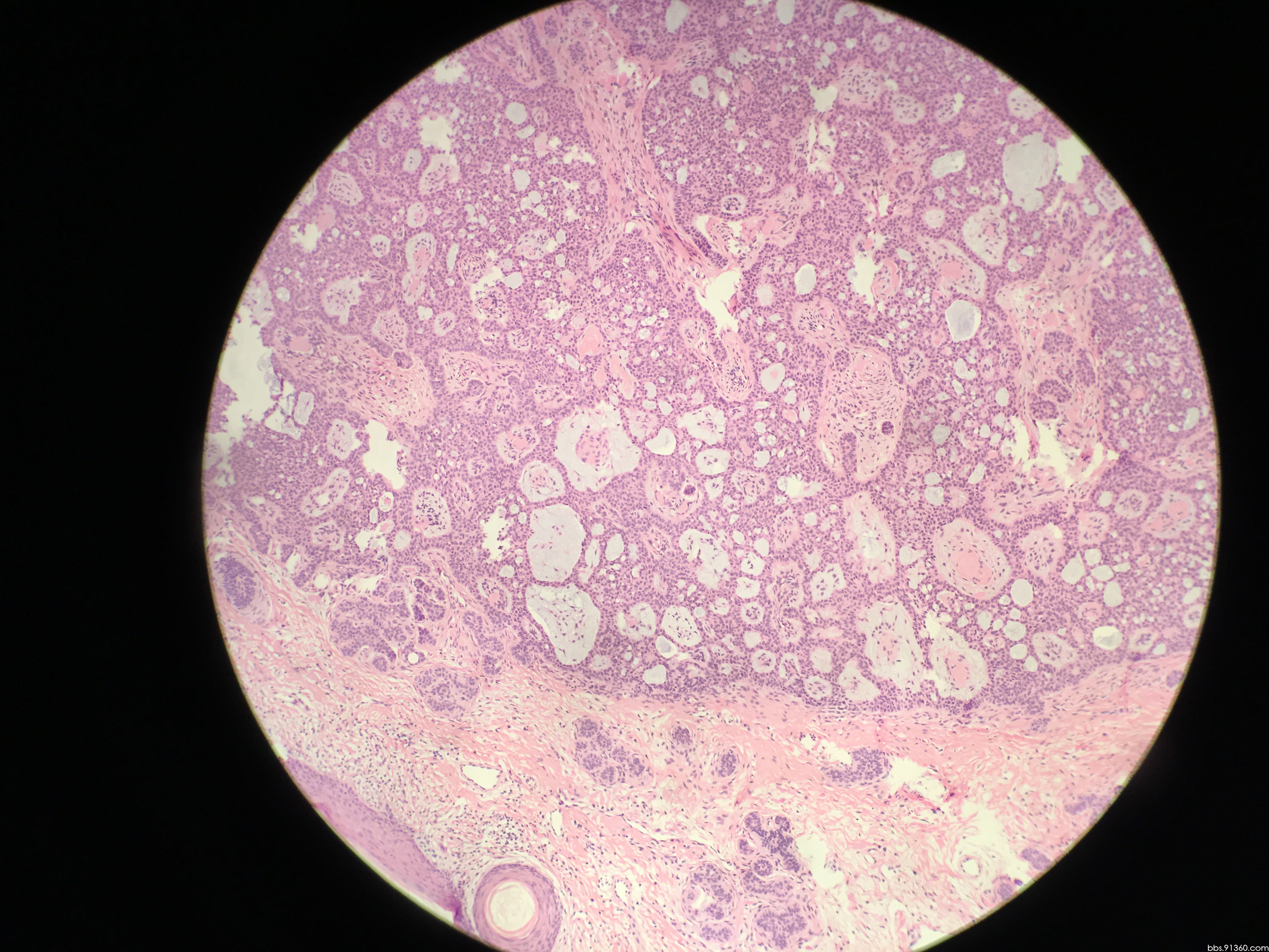 头皮肿物 - 皮肤病理 - 91360病理论坛