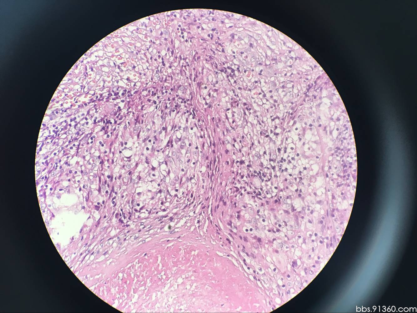 左锁骨上窝,淋巴结结核,2016/12/07【河南病理交流群病例5】