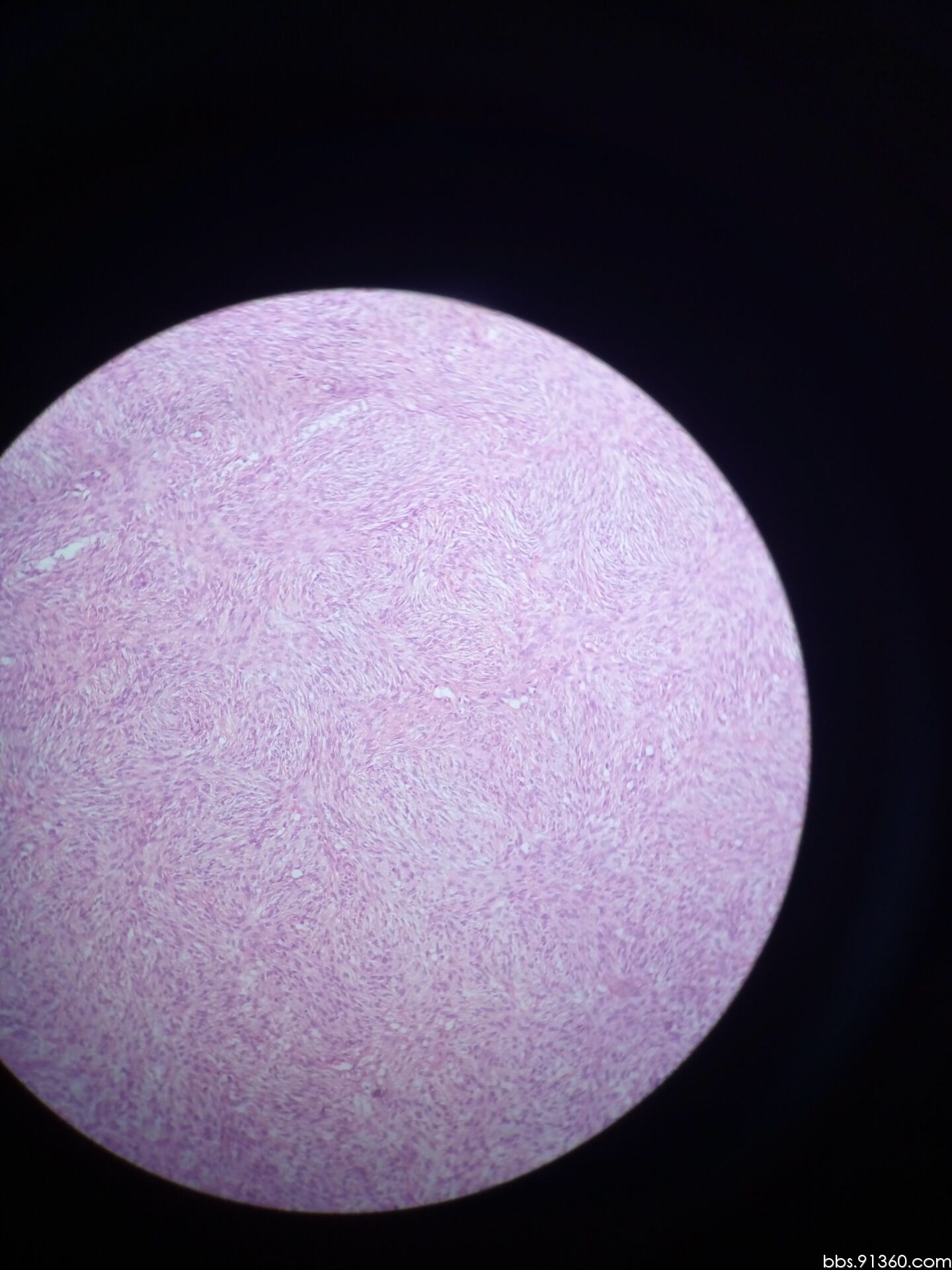 卵泡膜细胞瘤图片