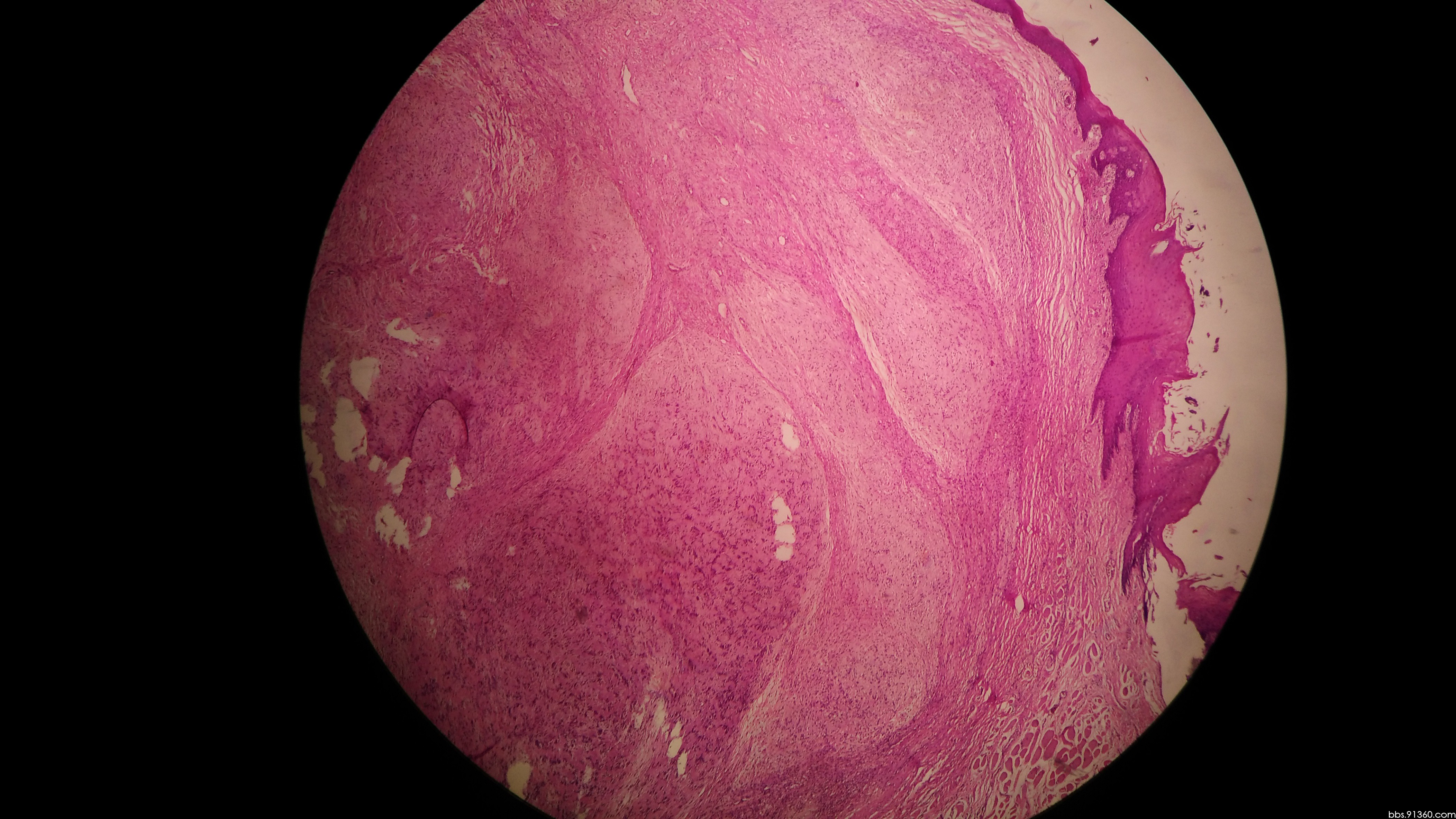 舌体肿物,从状神经鞘膜瘤,2016/12/22【河南病理交流群病例4】