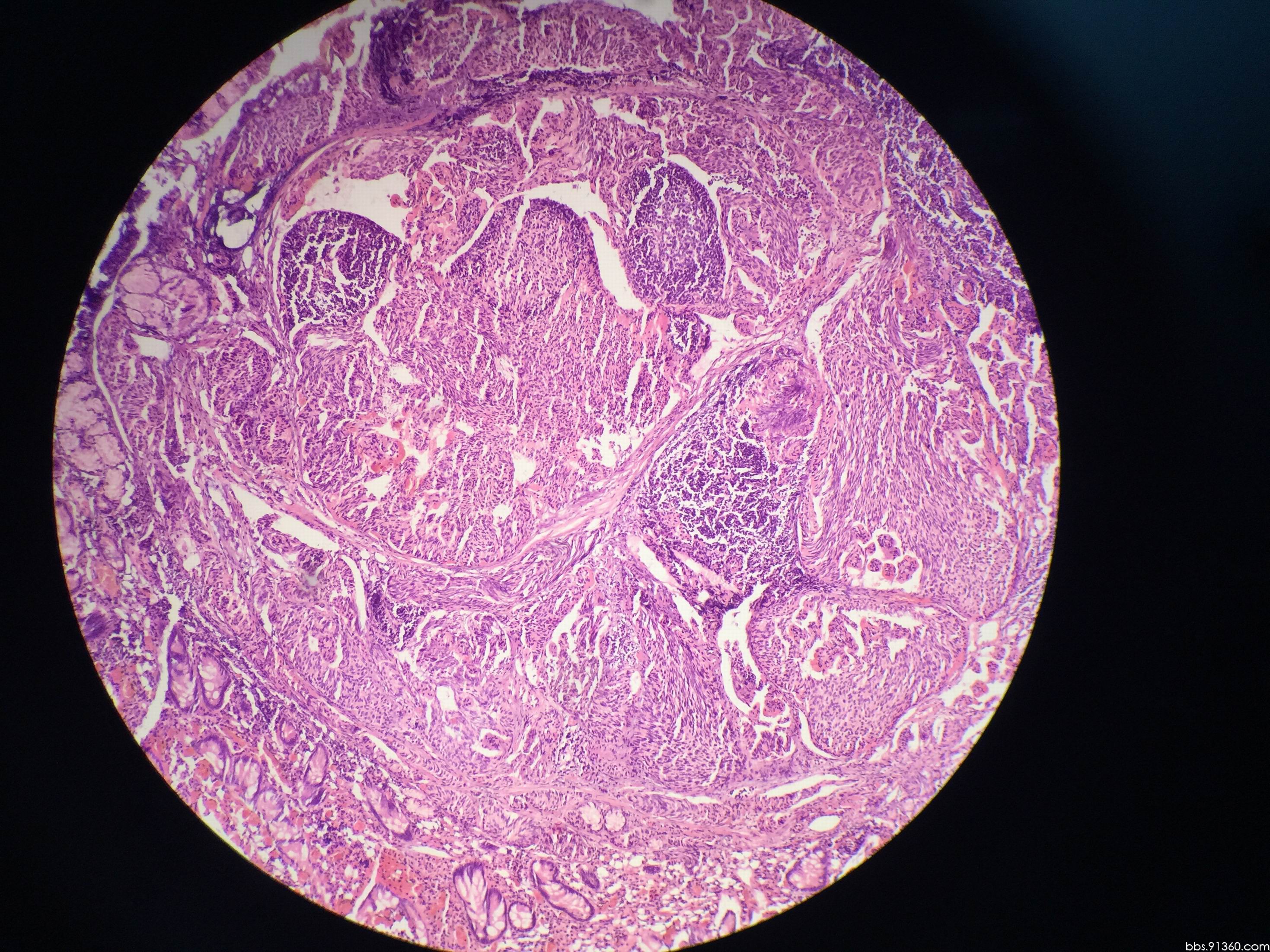 A Patient With Chronic Diarrhea of Unknown Cause - Clinical ...