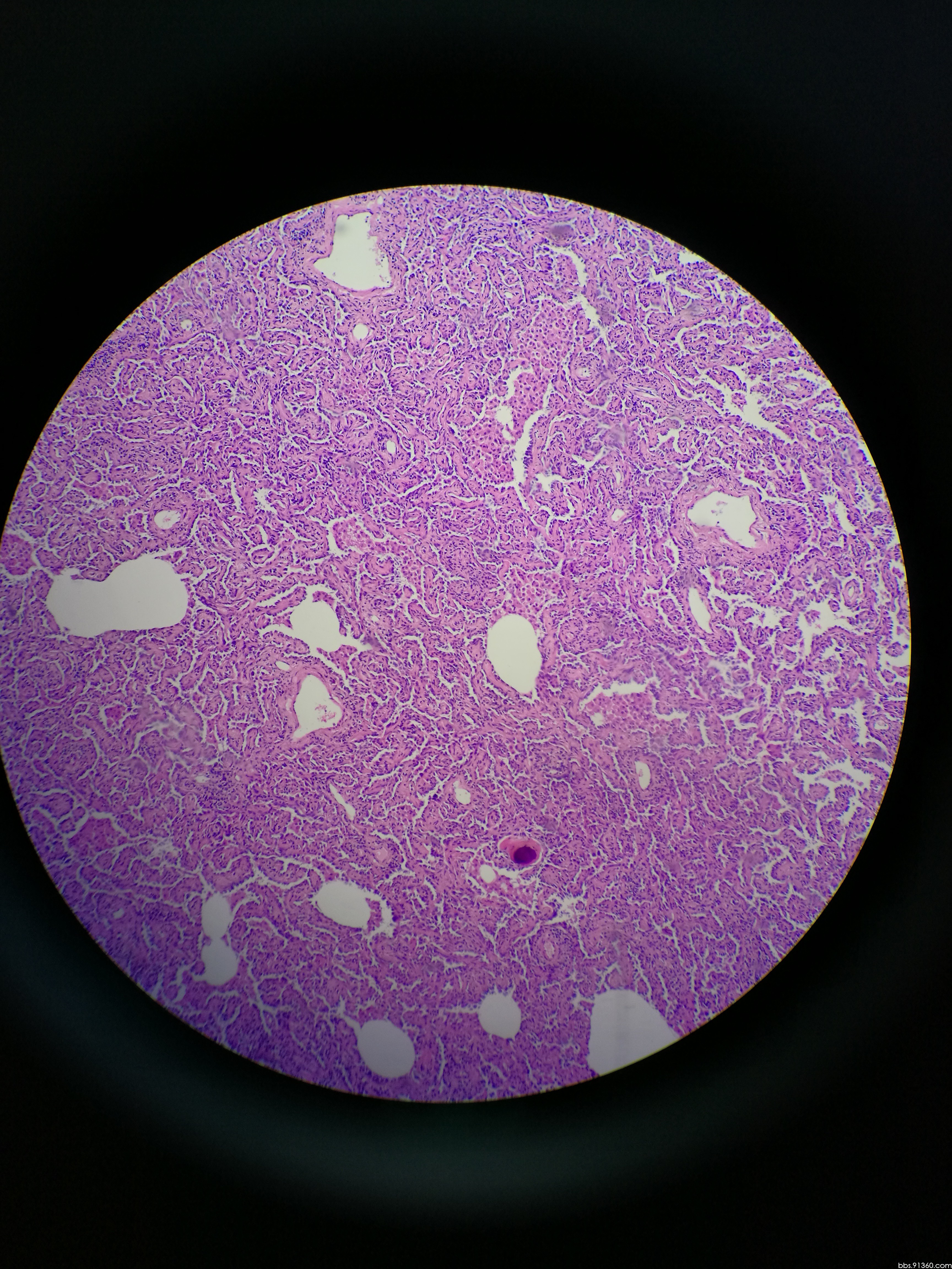 肺ggo 浸润性腺癌?讨论病例【胸部等器官疾病诊断论坛病例122】