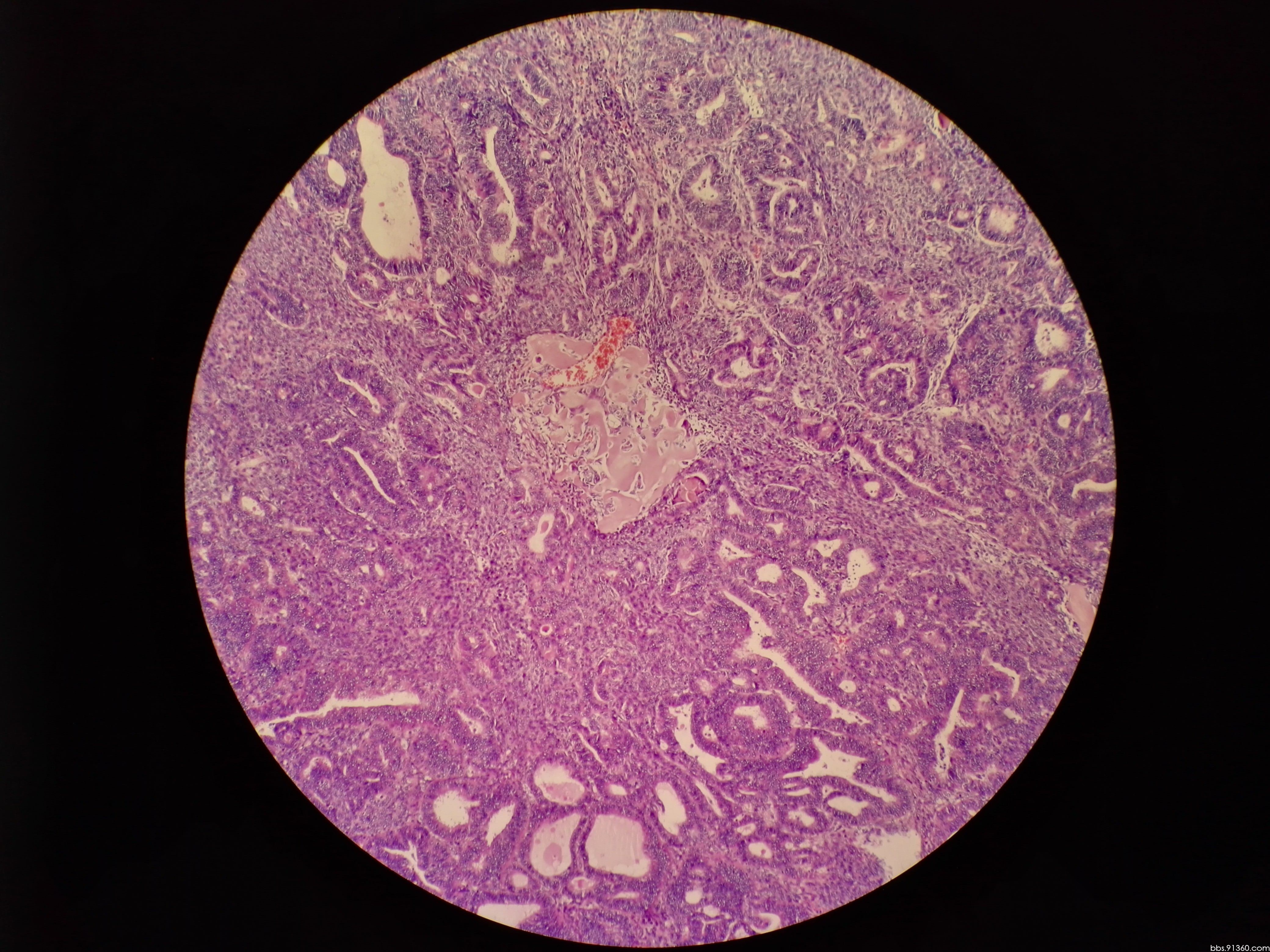 左卵巢 癌肉瘤12.22【91360妇科病理沙龙病例123】