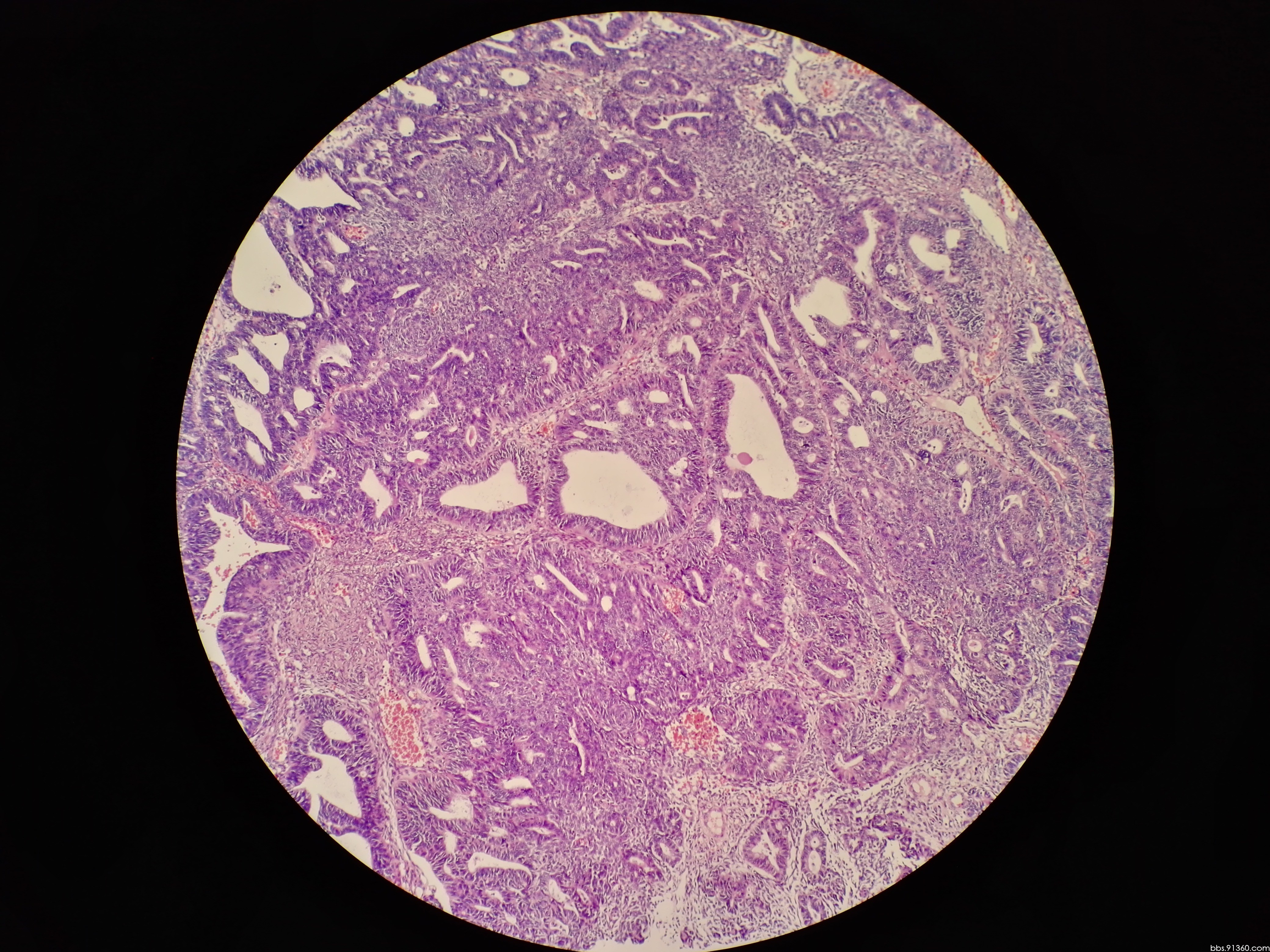 左卵巢 癌肉瘤12.22【91360妇科病理沙龙病例123】