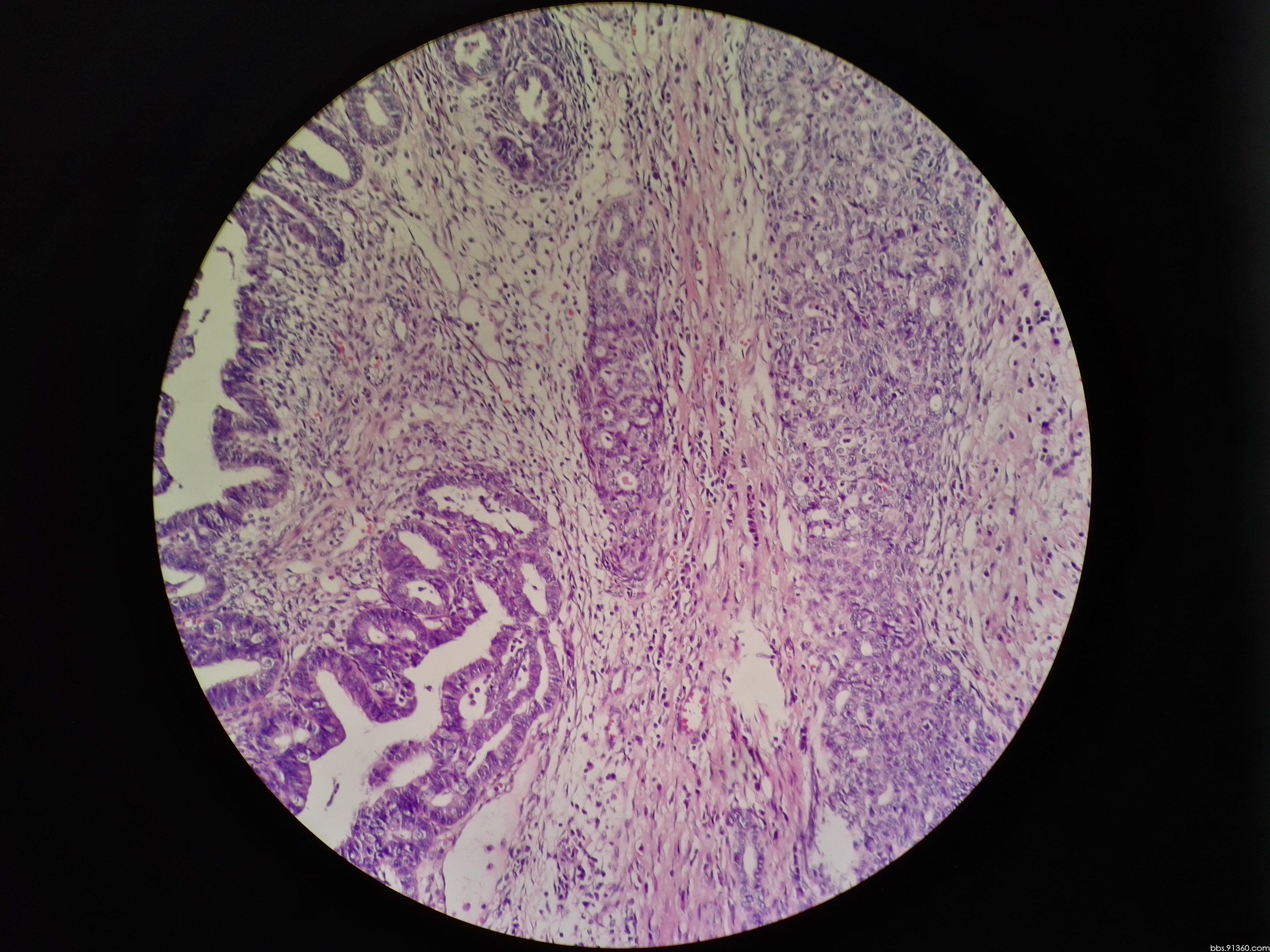 左卵巢 癌肉瘤12.22【91360妇科病理沙龙病例123】