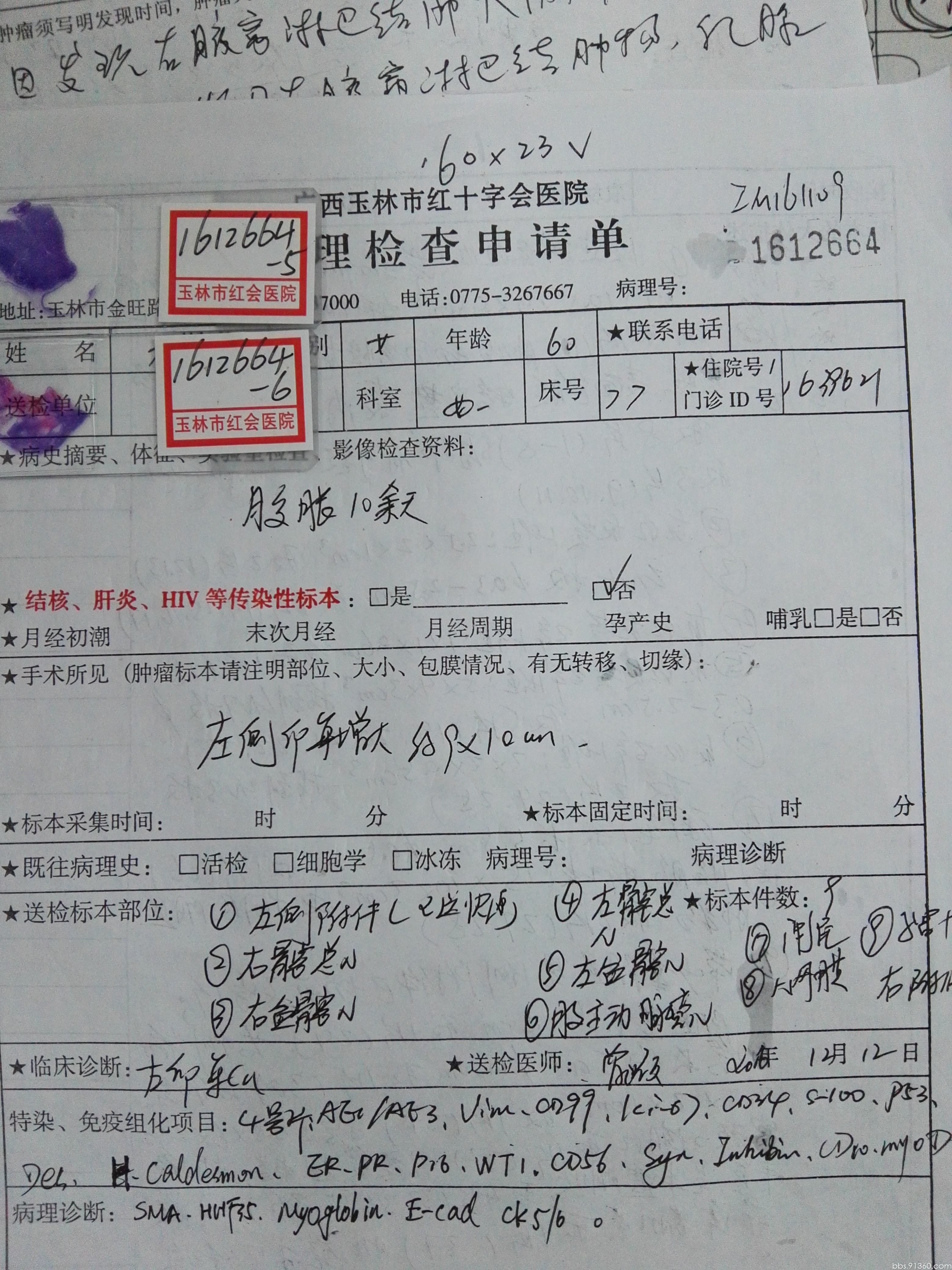 左卵巢 癌肉瘤12.22【91360妇科病理沙龙病例123】