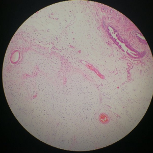 神经束膜瘤图片