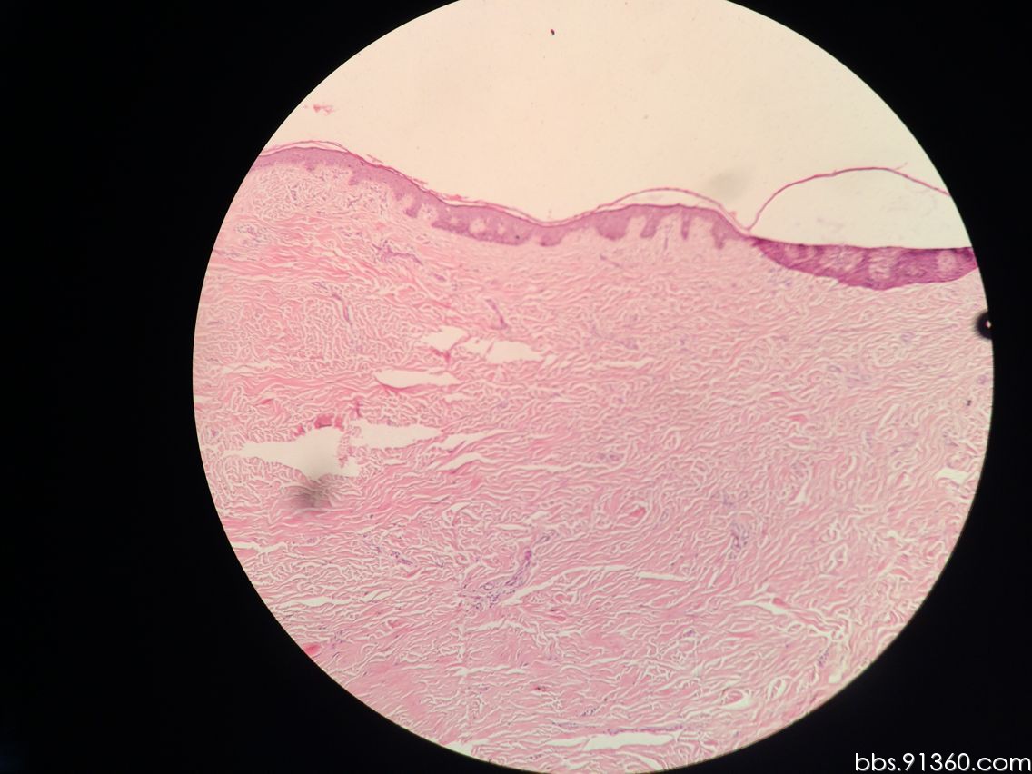 头皮组织,纤维组织细胞瘤,2016/1/16【河南病理交流群病例3】