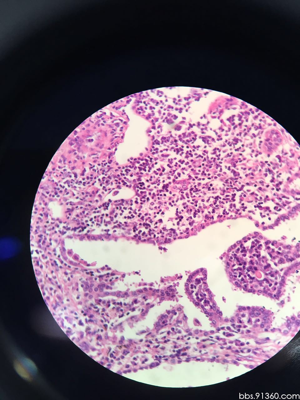 慢性炎症伴肺泡上皮反应性增生?