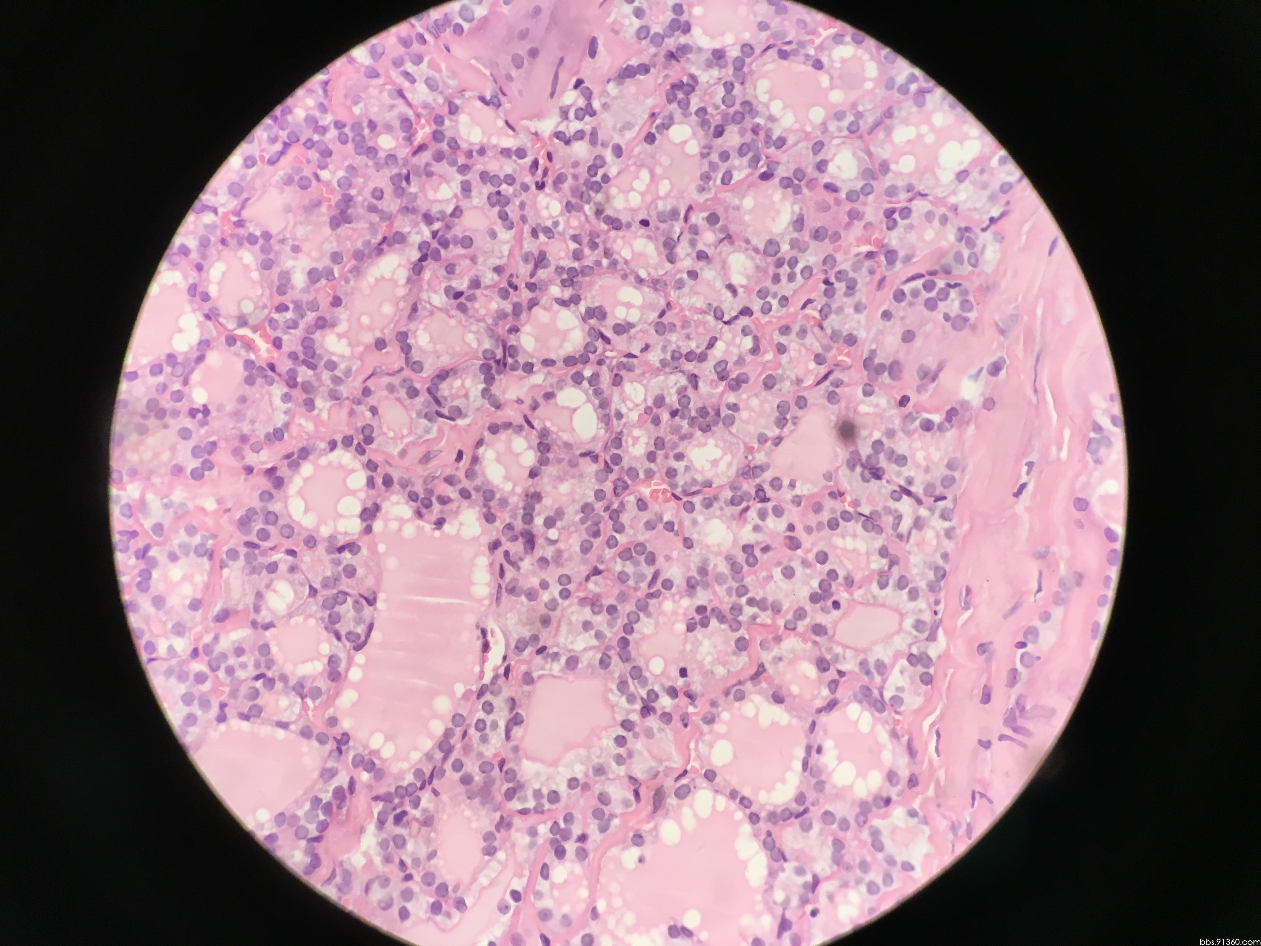 甲状腺左叶结节