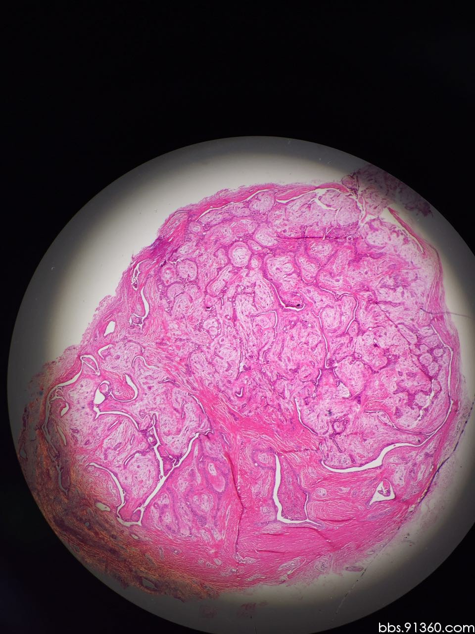 皮肤多形性腺瘤病例2017.2.4【91360皮肤沙龙病例132】