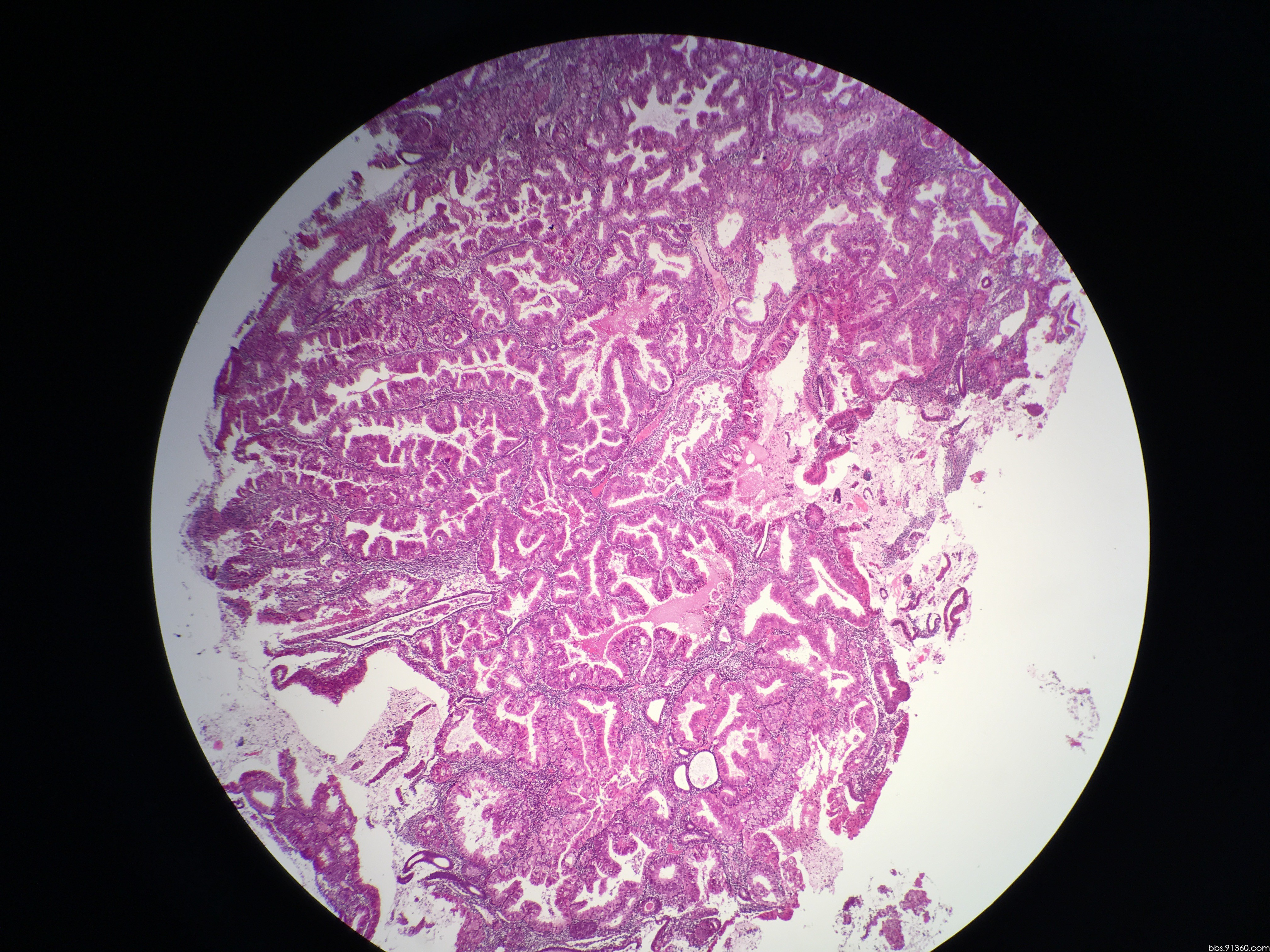 高分化腺癌图片