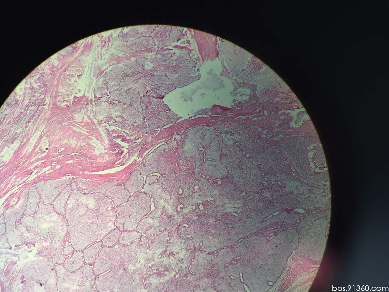 乳腺幼年型纤维腺瘤