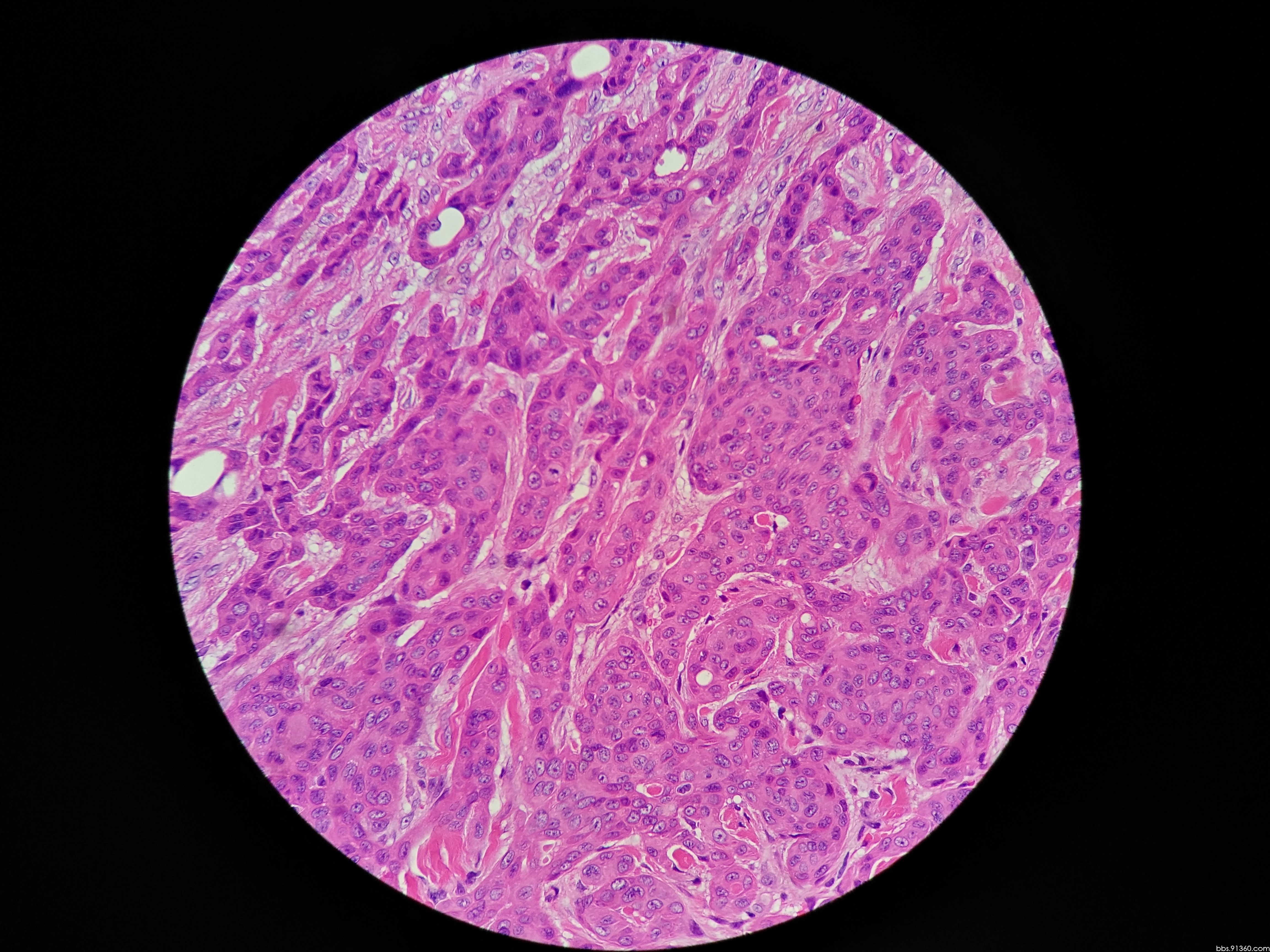 臀部肿物,汗腺癌,2017/2/15【河南病理交流群病例3】