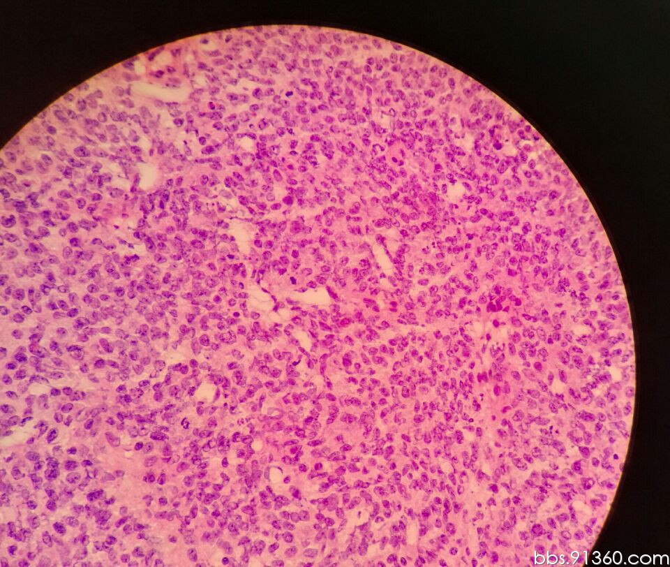 卵泡膜细胞瘤图片