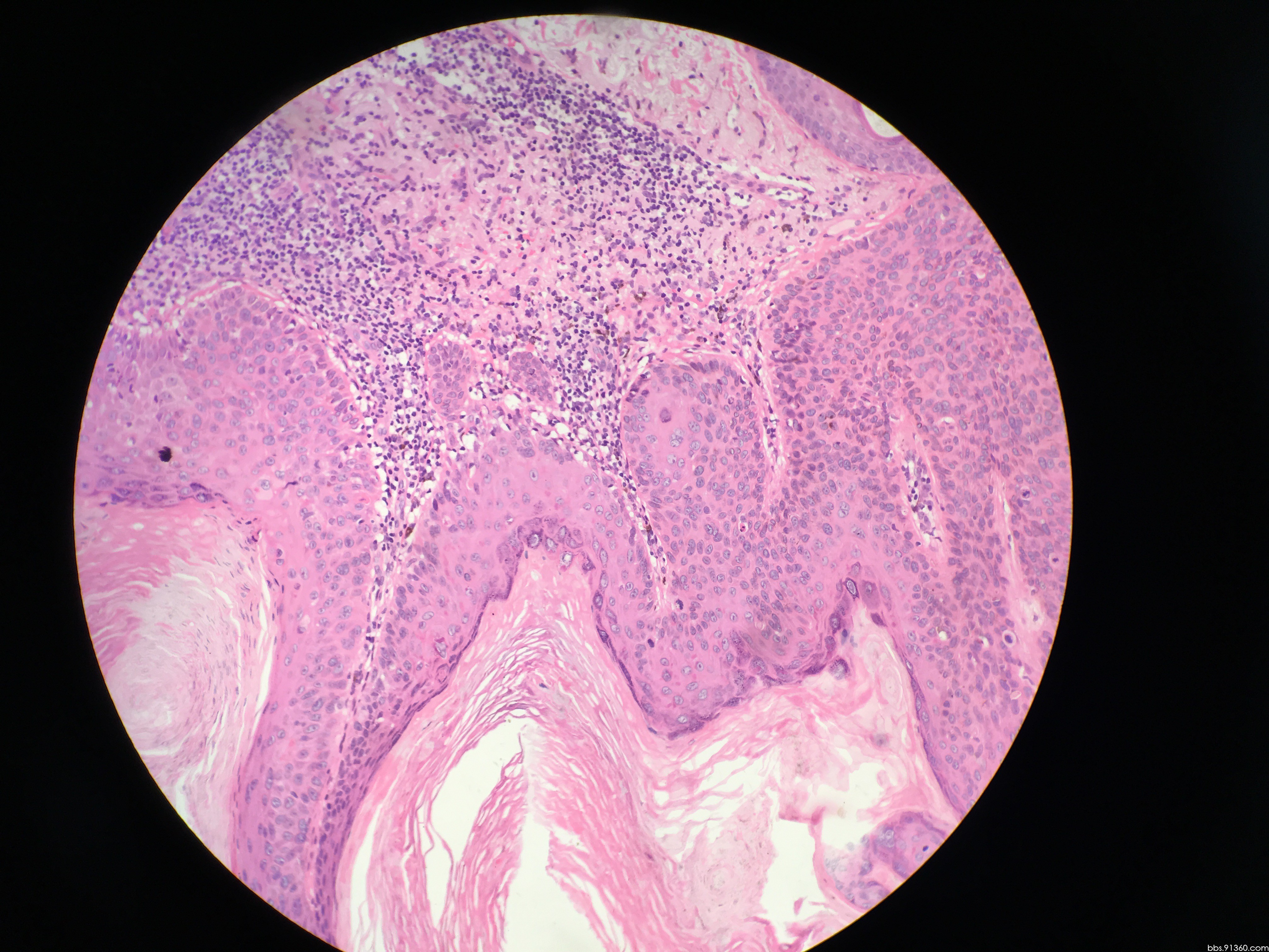 面部皮肤结节 - 皮肤病理 - 91360病理论坛