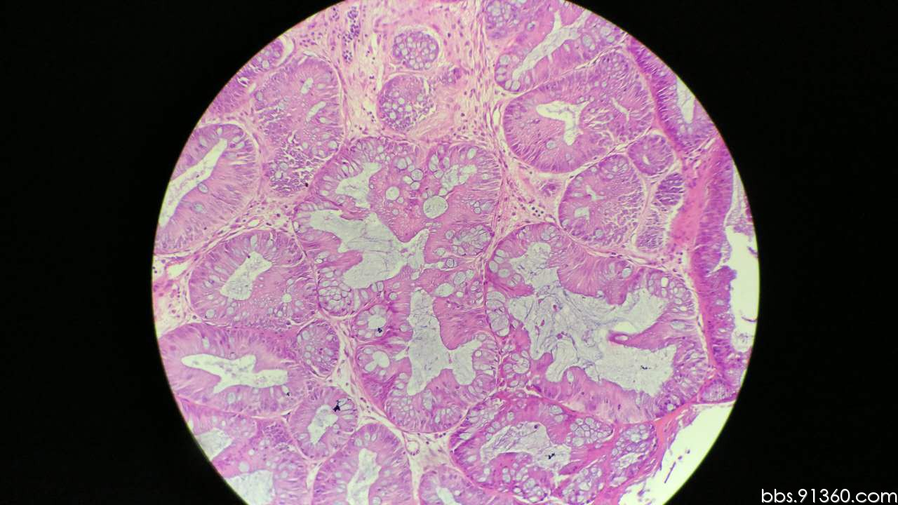 结肠管状腺瘤病理图片图片