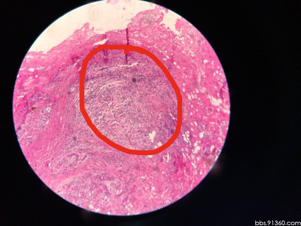 结核性肉芽肿显微镜图片