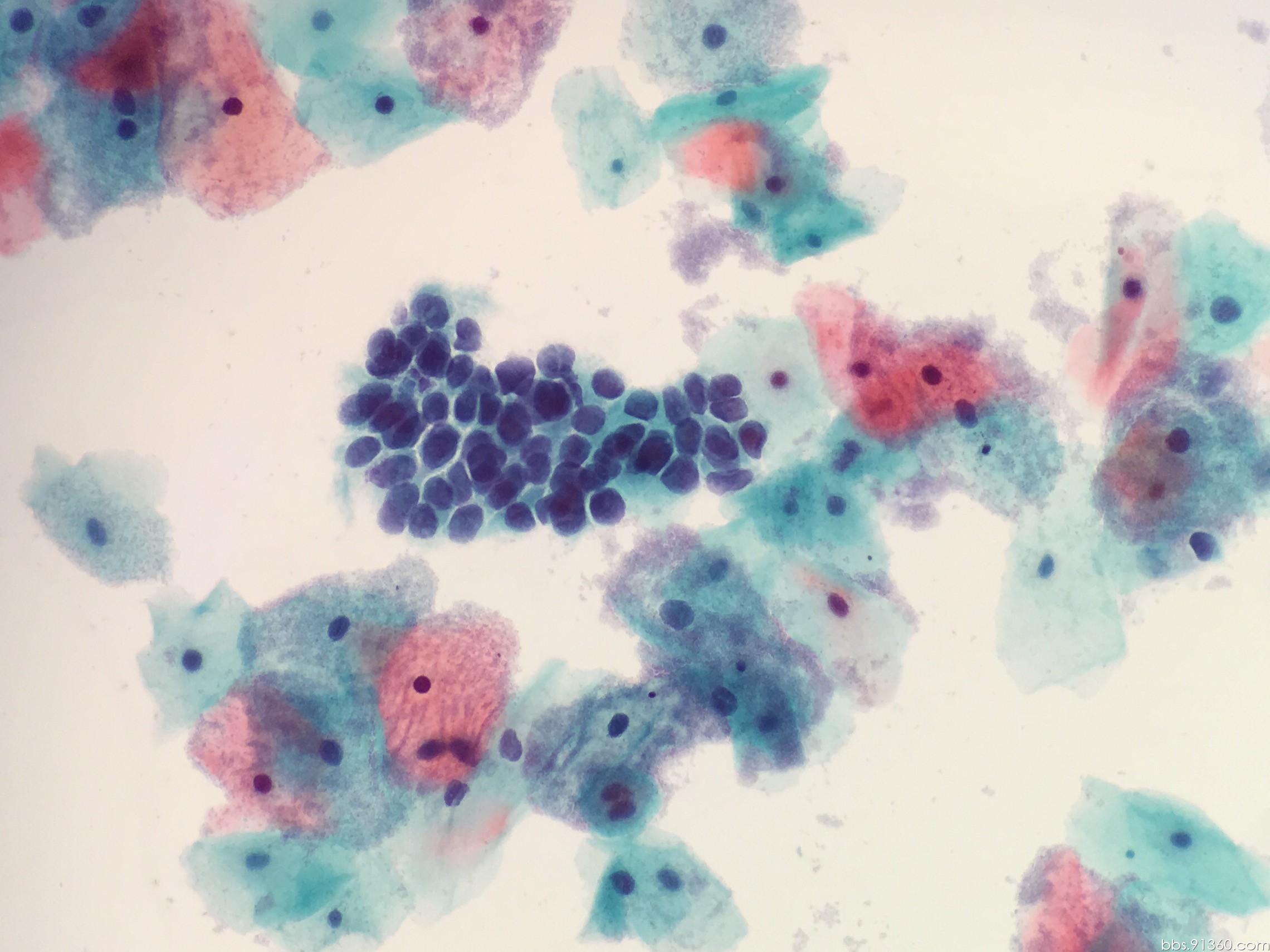显微镜下见异常鳞状上皮细胞。巴氏涂片细胞学检查HPV标准。照片摄影图片_ID:427177999-Veer图库