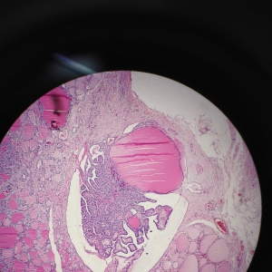 结节性甲状腺肿病理图片