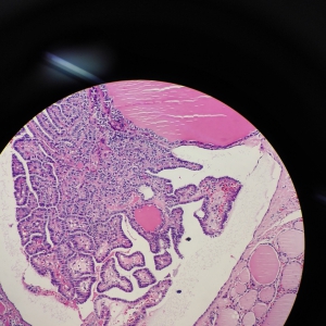 结节性甲状腺肿病理图片