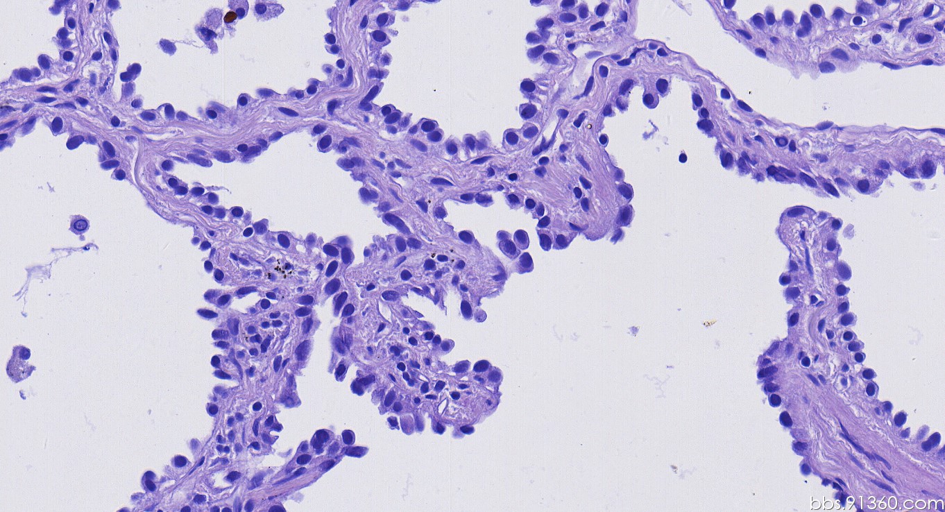 微浸润腺癌图片