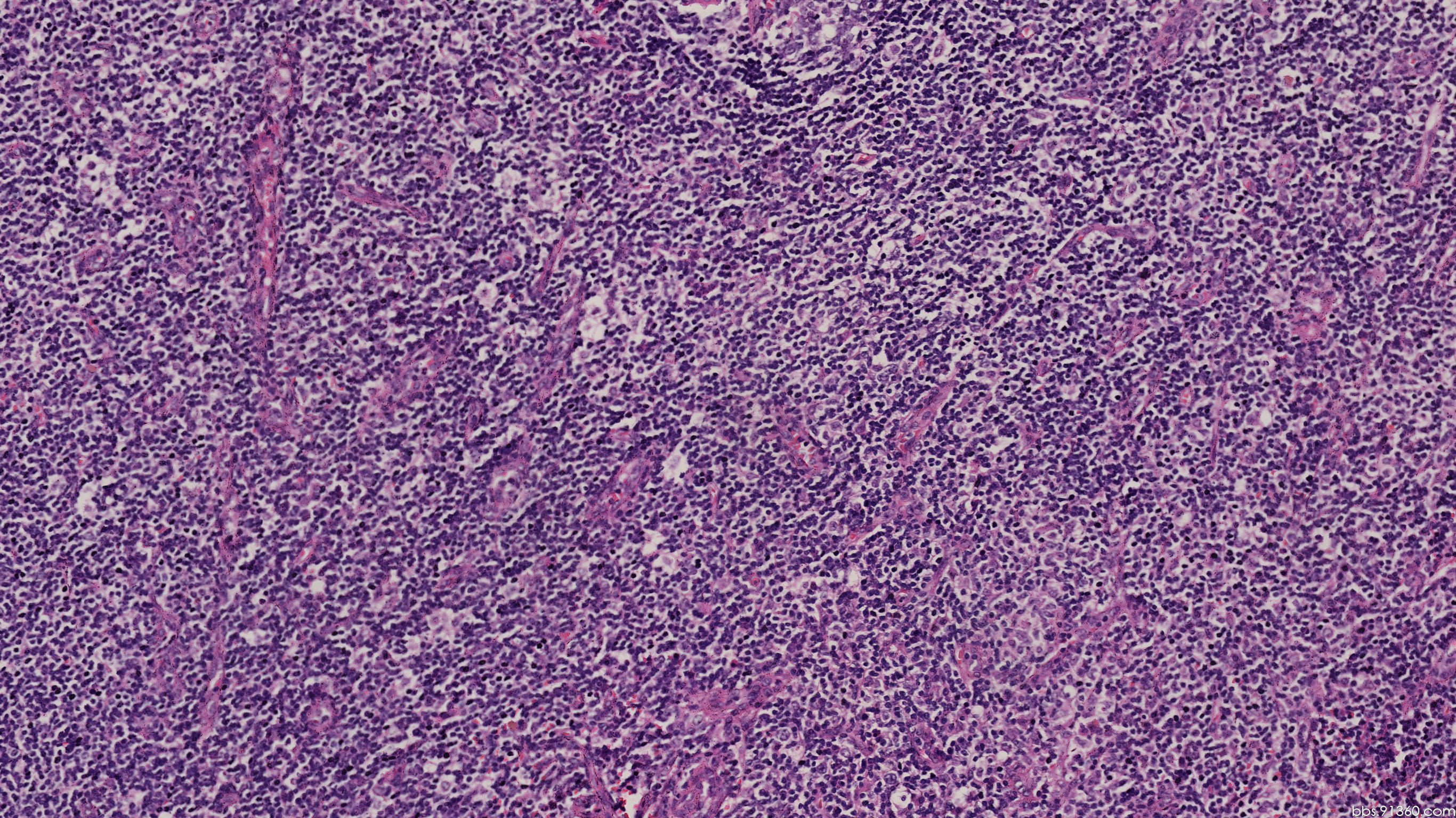 60.SLE淋巴结病理(HE染色):组织细胞反应性增生-内分泌-医学