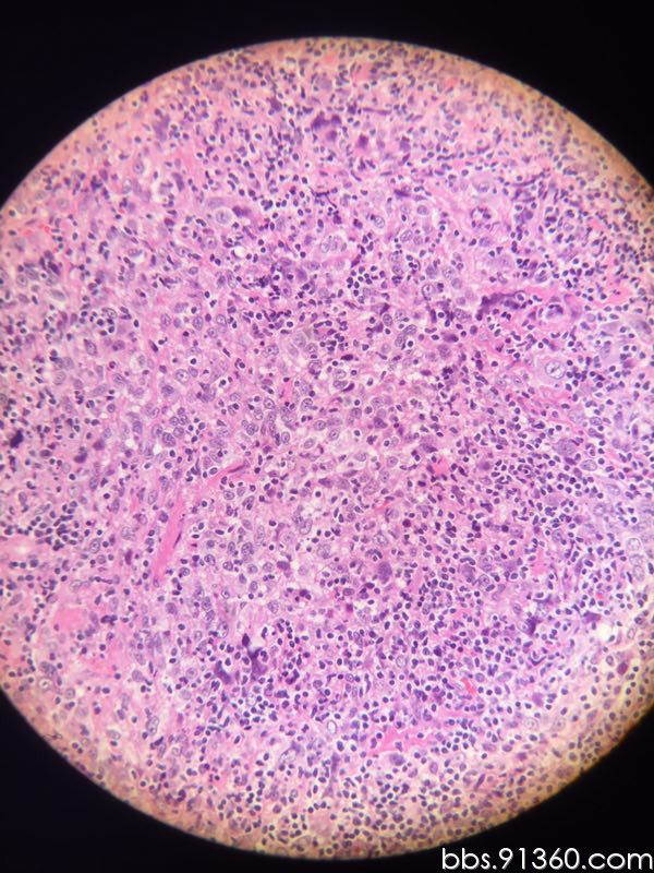 卵巢 低分化癌讨论病例【中美加卵巢肿瘤病理交流群病例33】