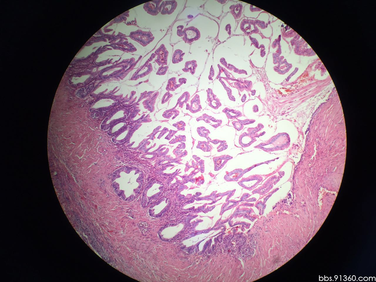 卵巢肿物 黏液性交界性肿瘤局部癌变讨论病例【中美加卵巢肿瘤病理