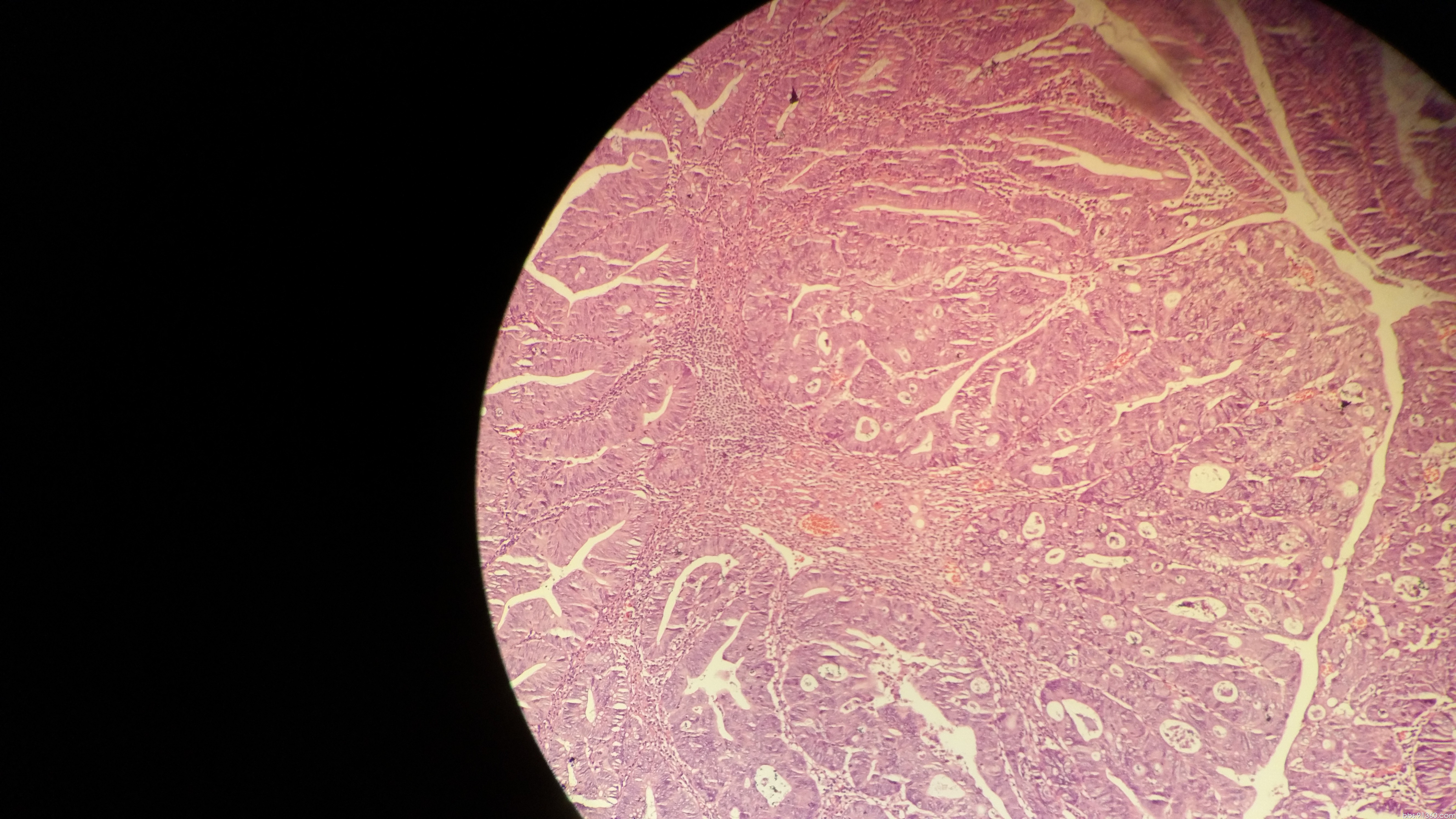 绒毛状管状腺瘤图片