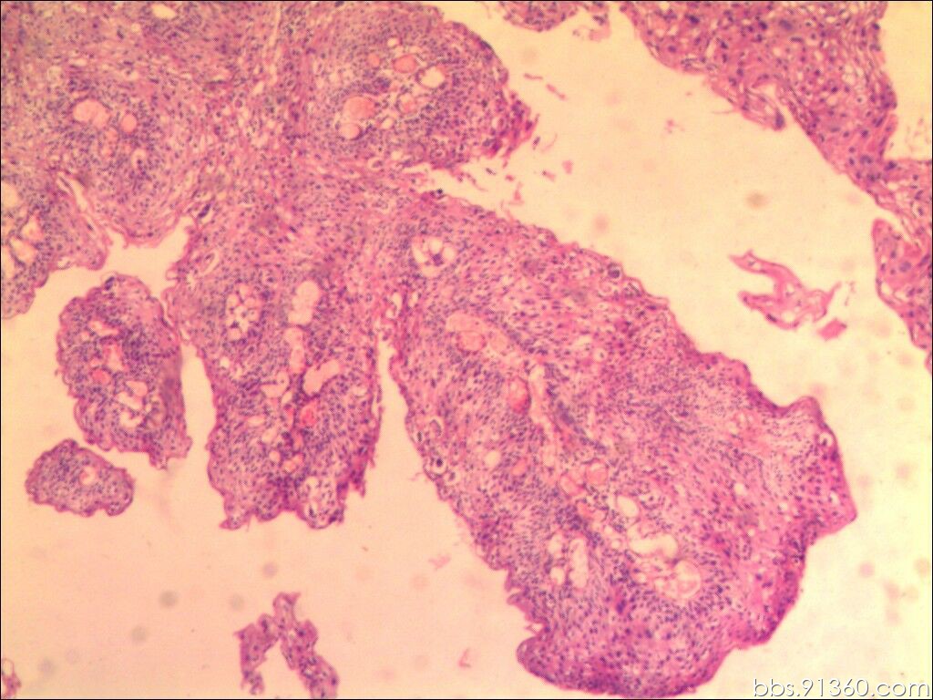 【8.1病例读片】龟头上有一个肉色结节性肿块，表面有溃疡，临床上怀疑鳞状细胞癌。 - 泌尿和男性生殖系统 - 91360病理论坛
