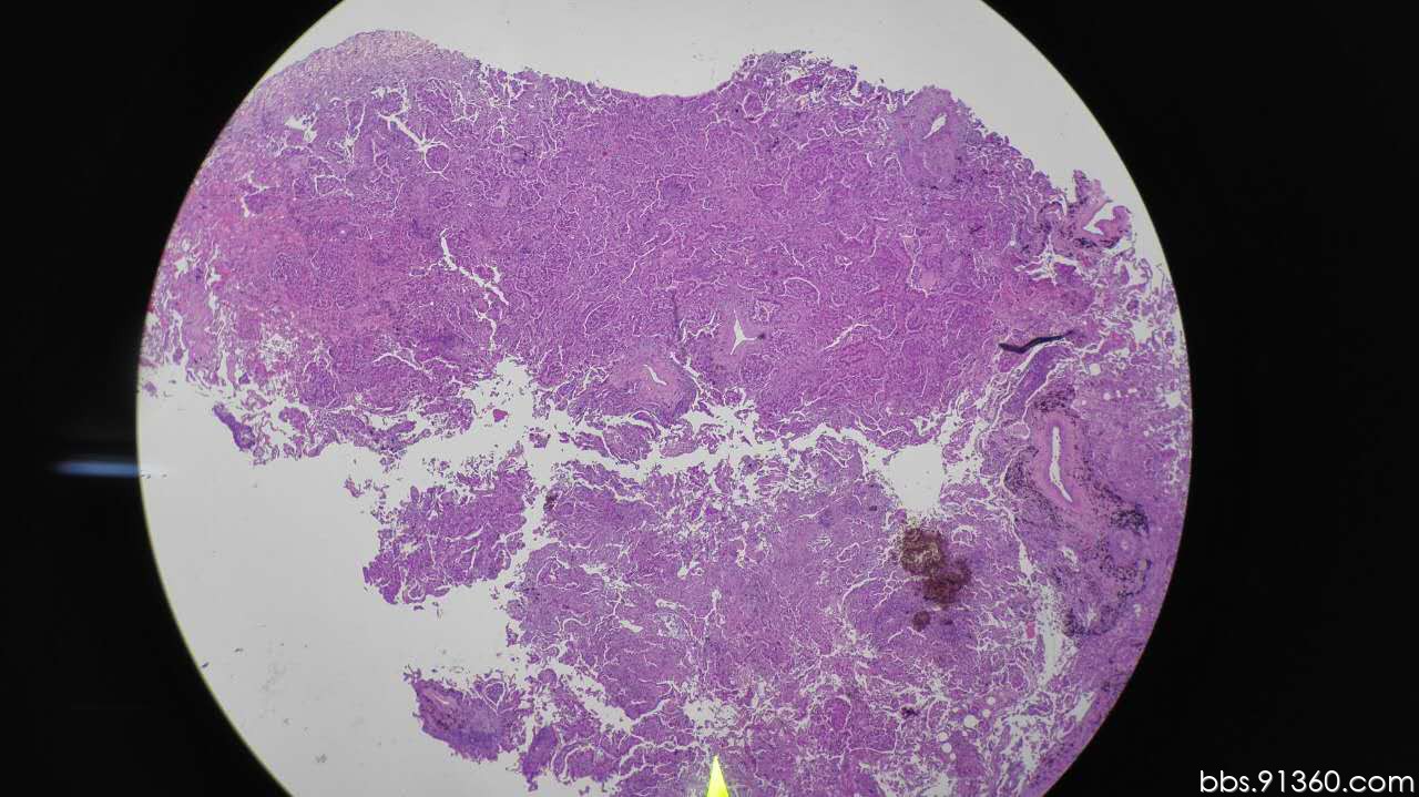 肺结节 浸润性腺癌讨论病例【胸部等器官疾病诊断论坛病例145】