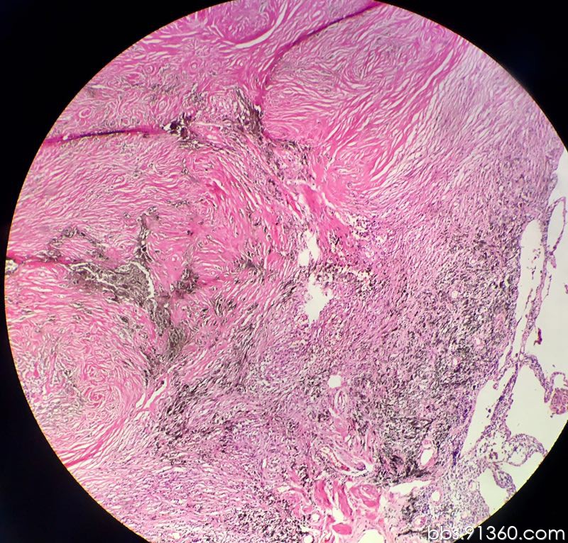 左肺下叶 伴有陈旧性坏死的纤维化结节讨论病例【胸部等器官疾病诊断