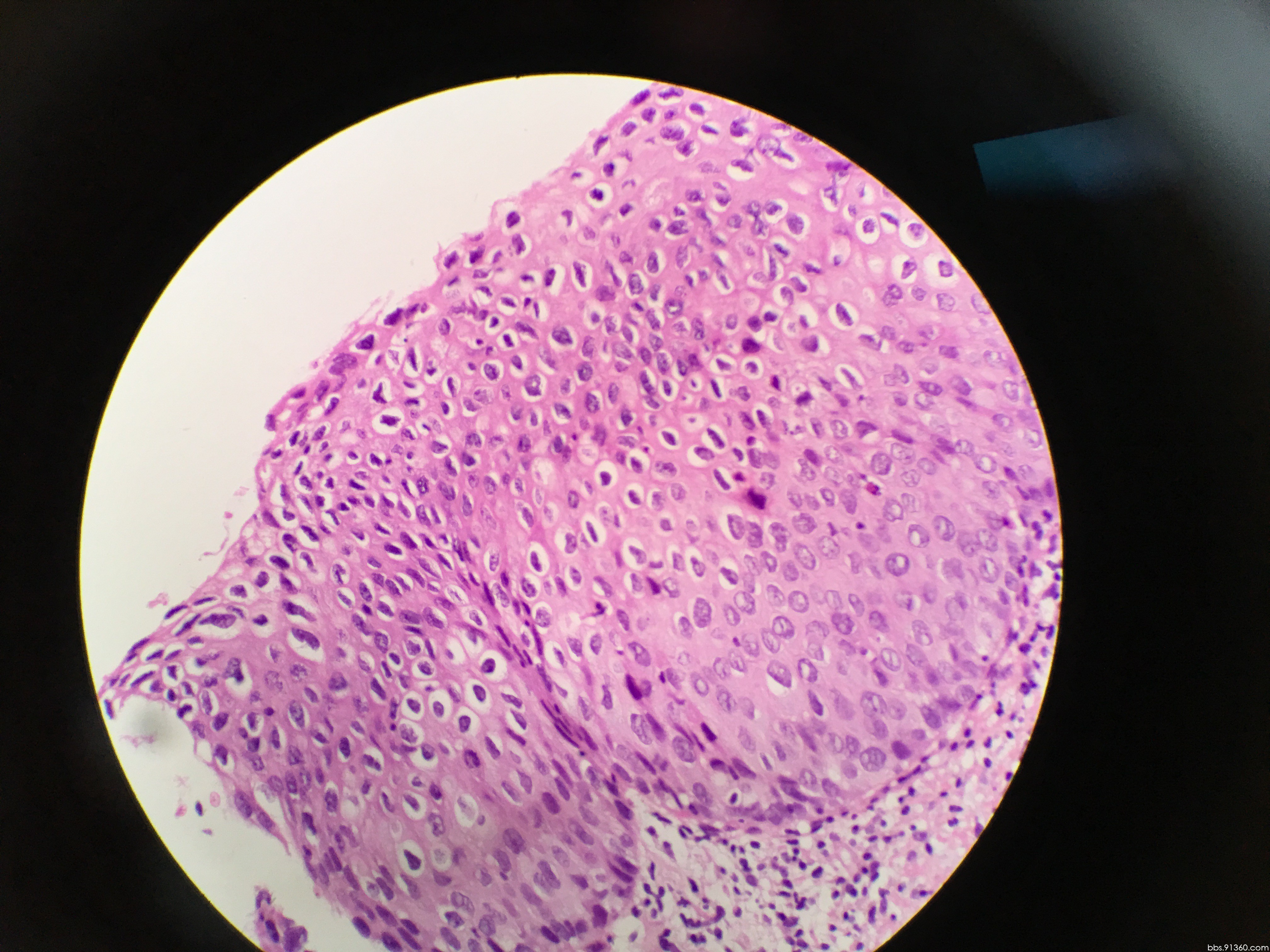 宫颈活检为鳞状上皮高度病变病例【中美加宫颈病理学交流群病例1】 - 中美加宫颈病理学交流群 - 91360病理论坛