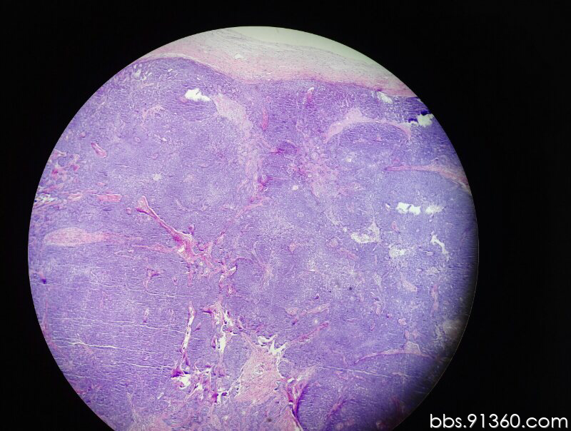 基底细胞癌皮肤镜图片