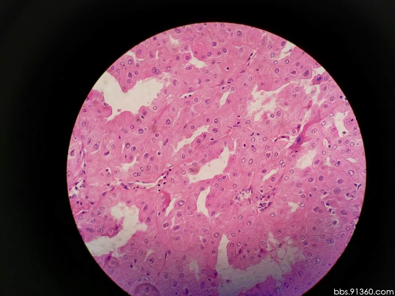 肾脏,嫌色细胞癌?2017.4.24【91360泌尿沙龙整理123】