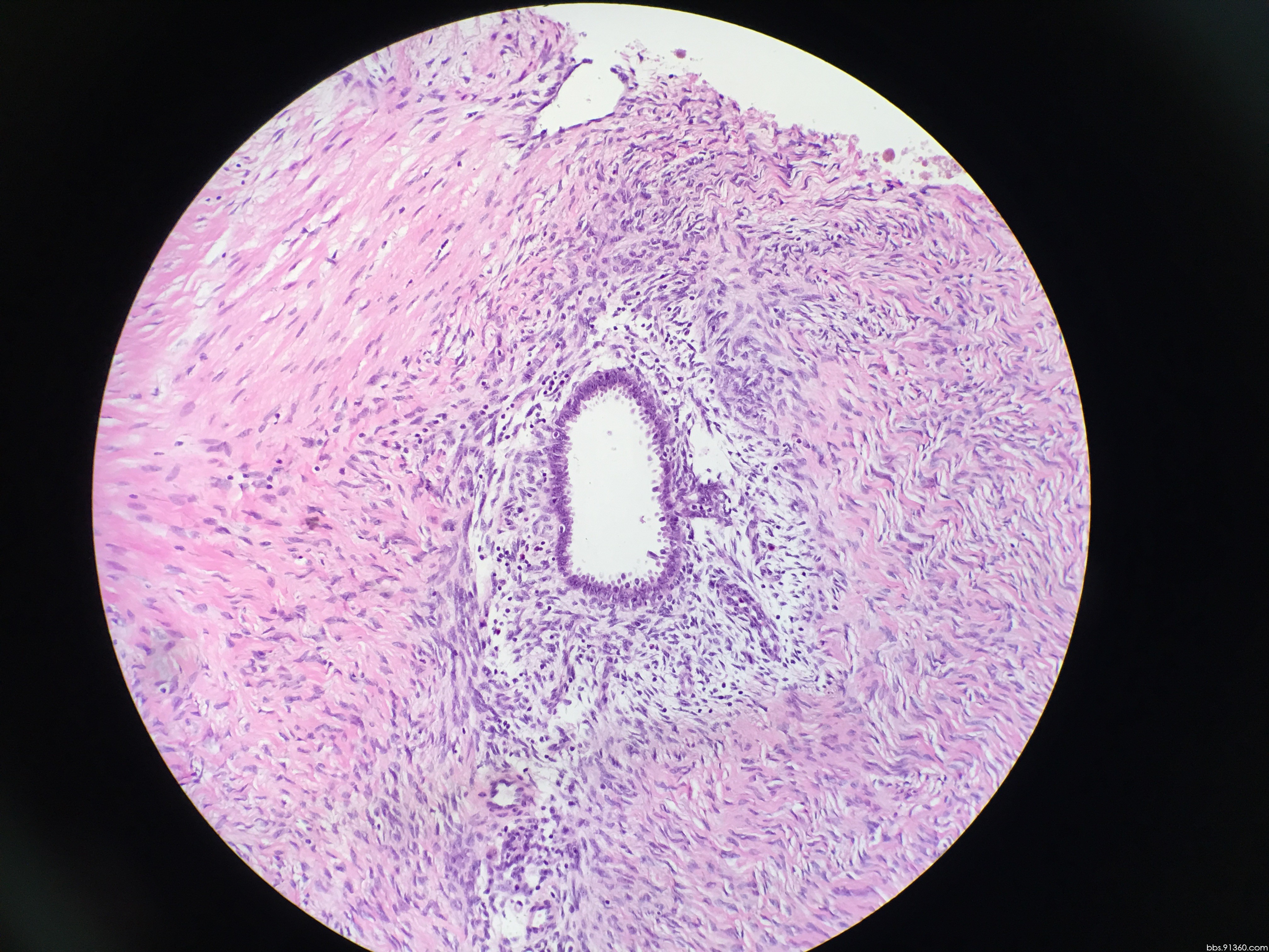 交界性子宫内膜样肿瘤【中美加卵巢肿瘤病理交流群病例56】
