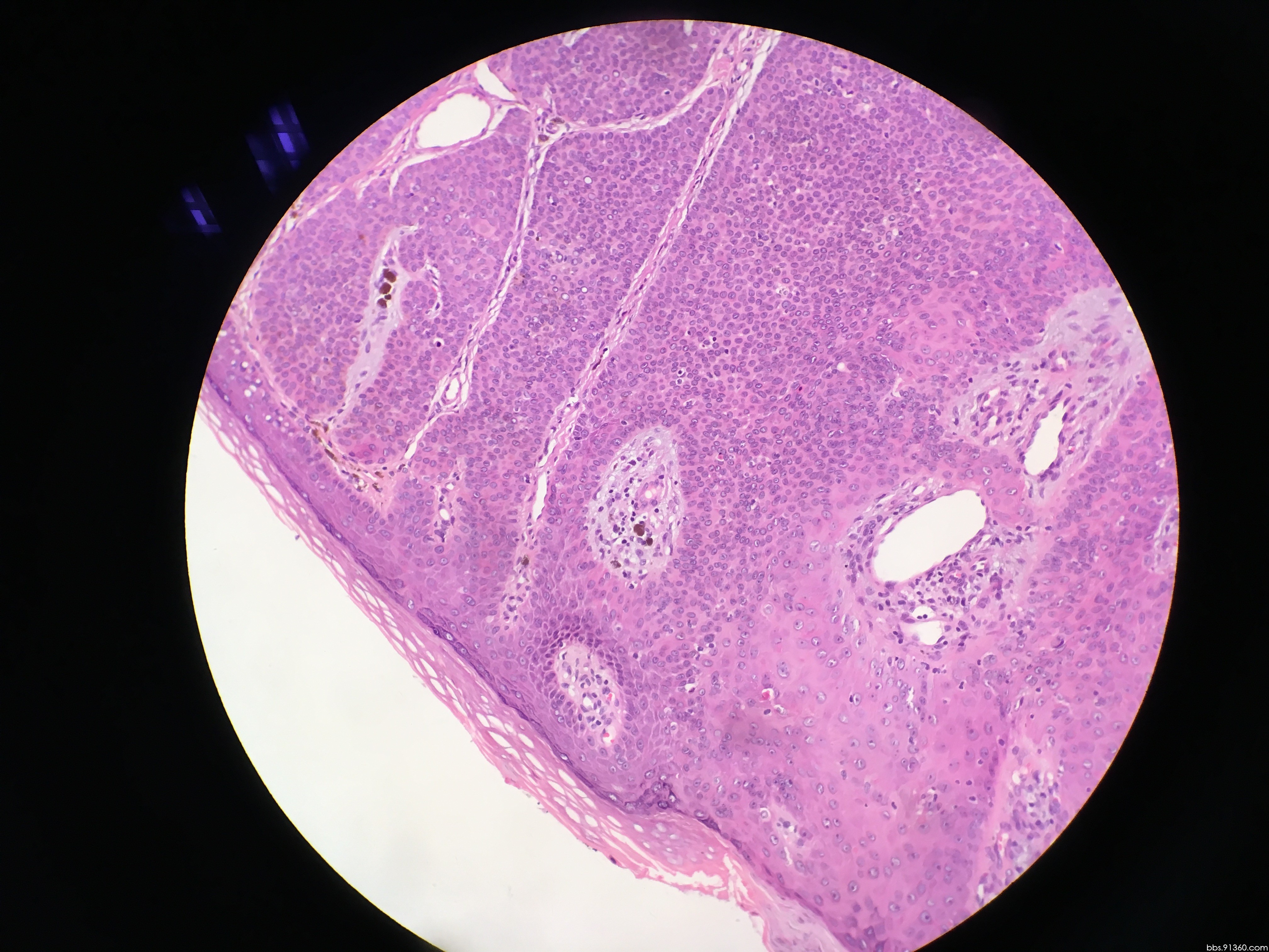 皮肤结节 - 皮肤病理 - 91360病理论坛