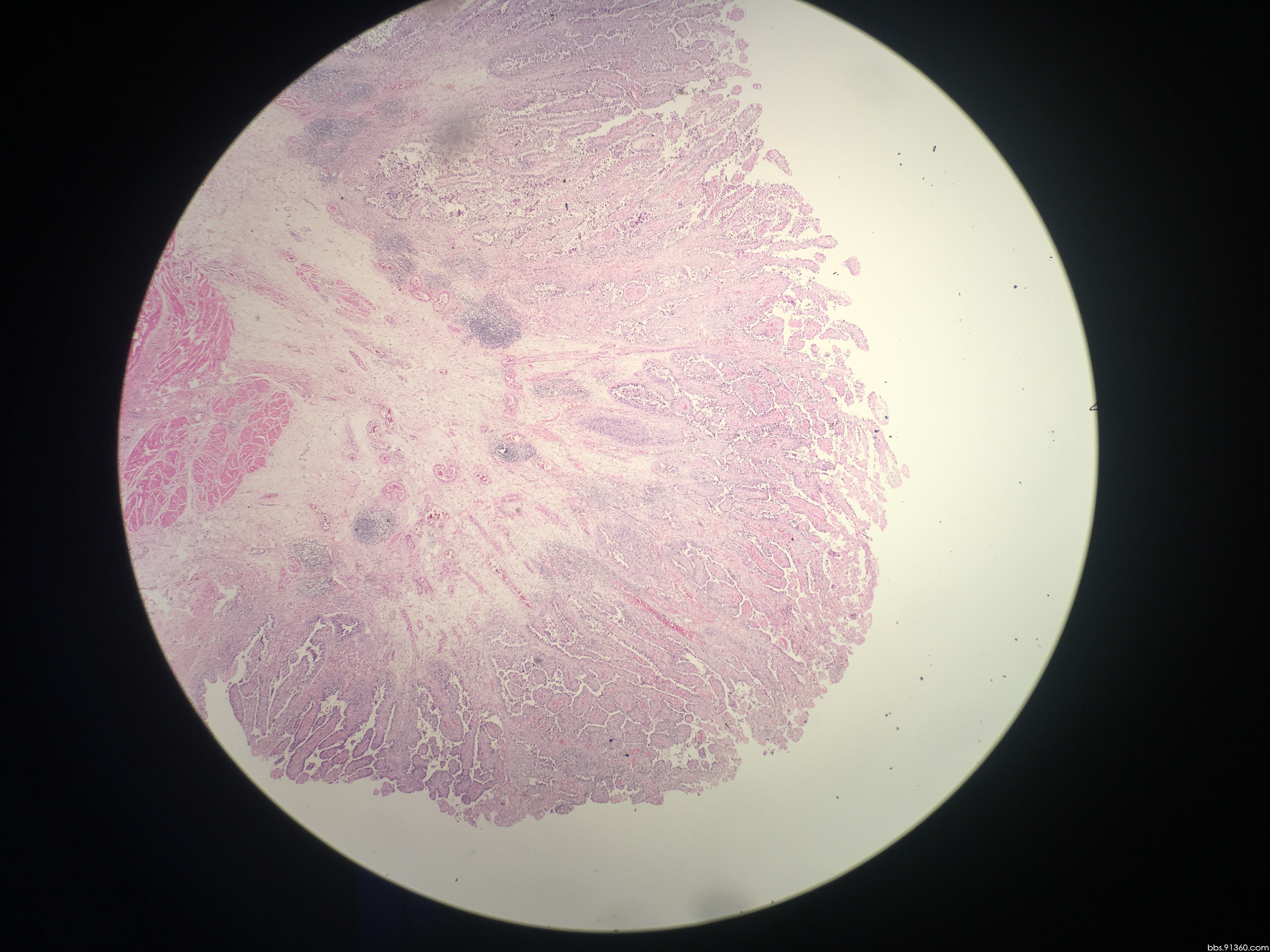 膀胱壁高级别乳头状尿路上皮癌2017.06.