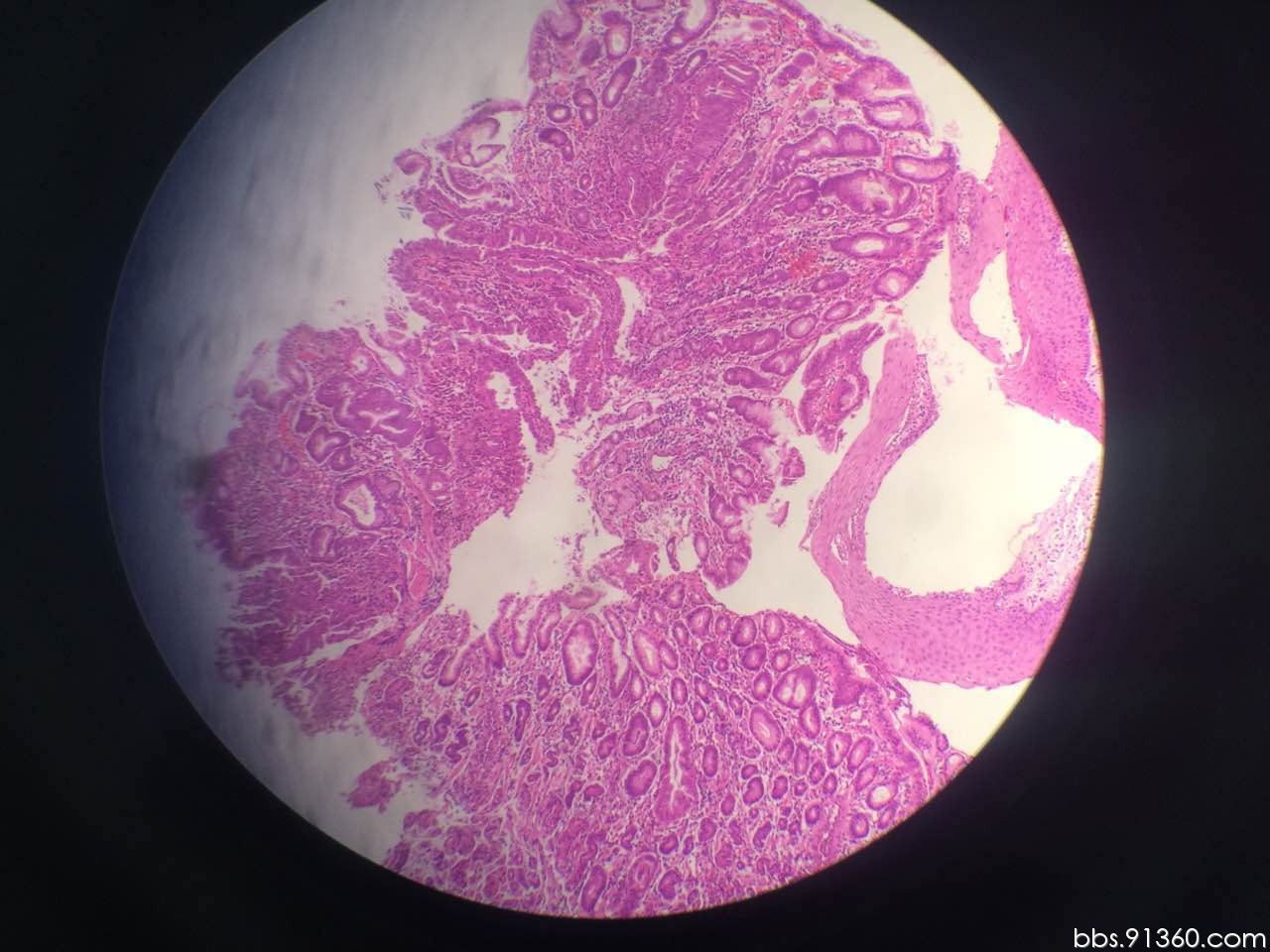 胃底-贲门癌讨论2017.06.12【91360消化沙龙病理278】