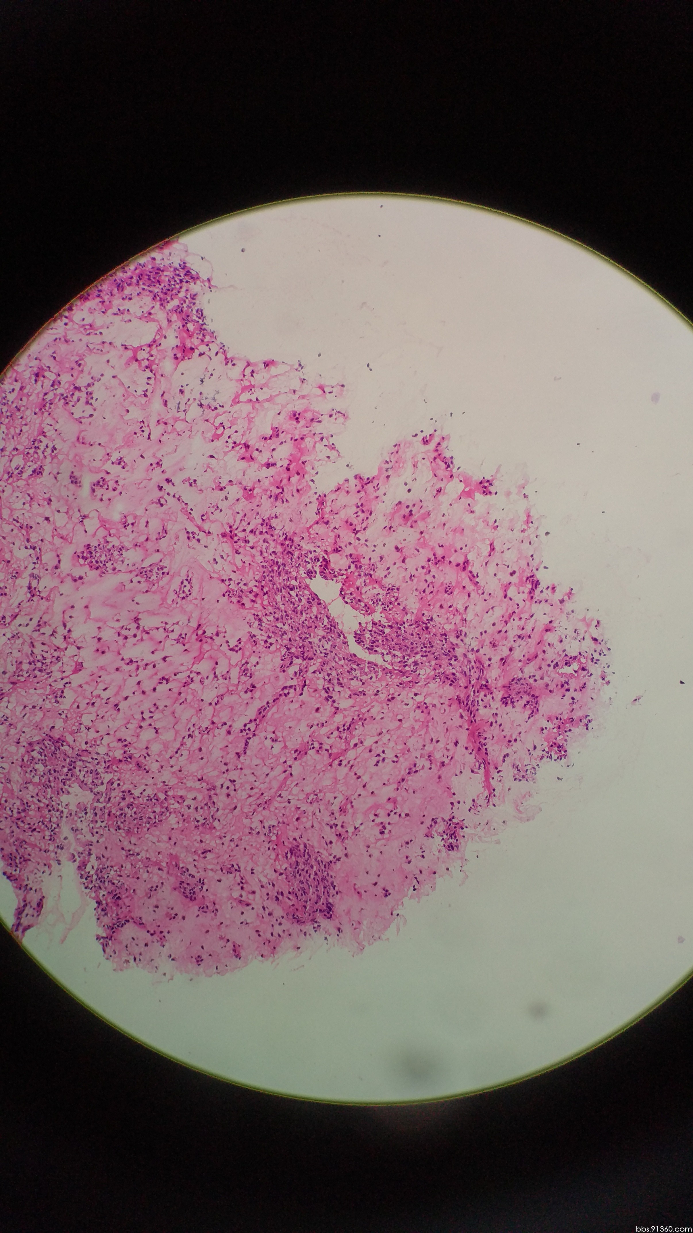 乳腺冰冻特殊类型的浸润癌?讨论2017.06.